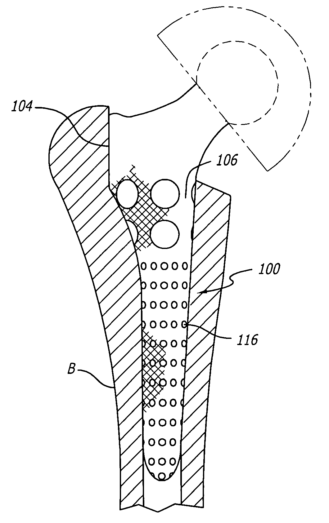 Orthopedic implant surface configuration with a projection having a back cut