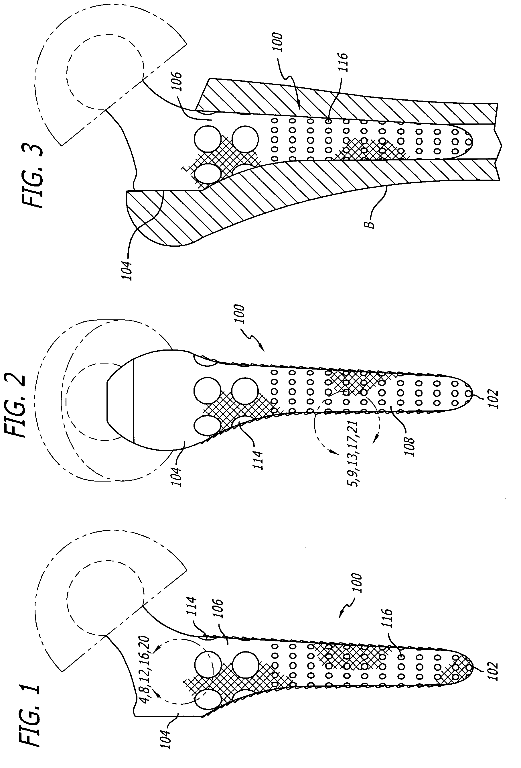 Orthopedic implant surface configuration with a projection having a back cut