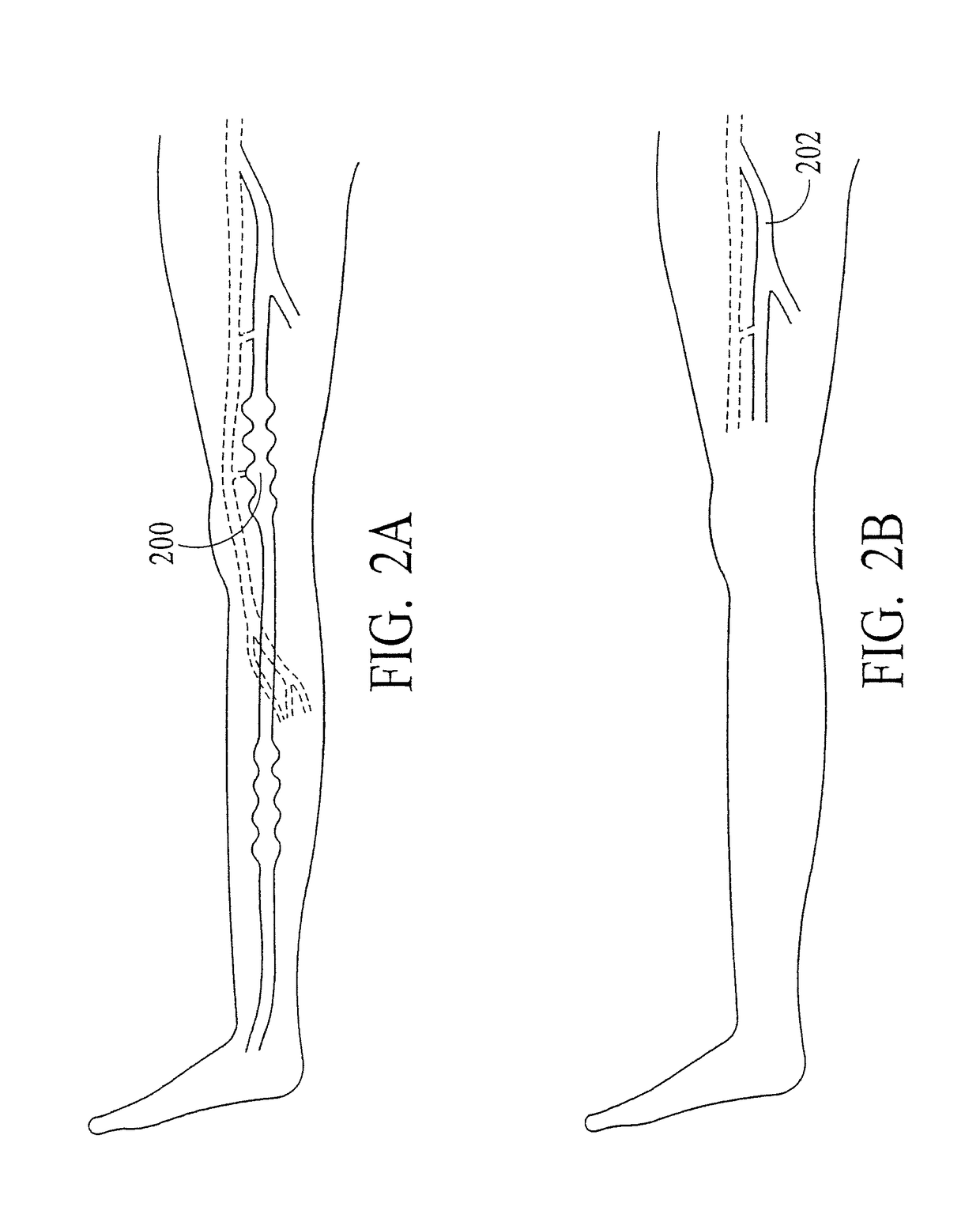 System and method for endovenous treatment of varicose veins with mid infrared laser