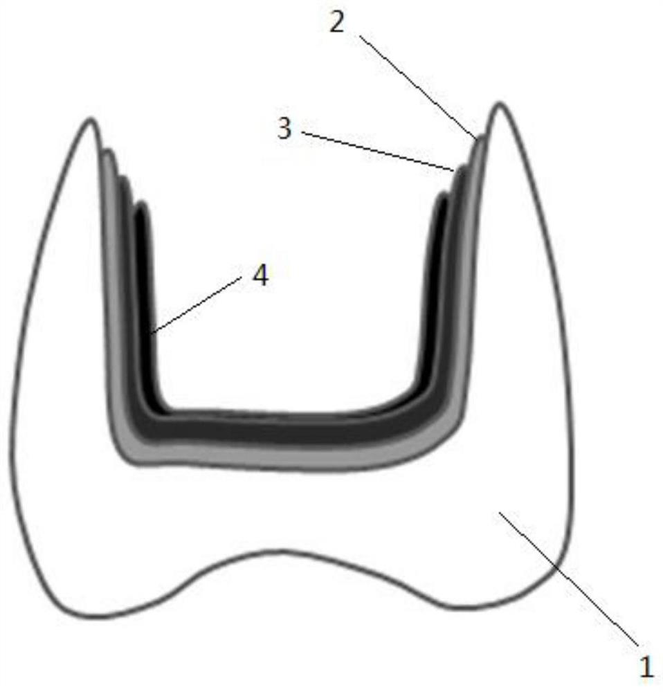 A shade-opaque zirconia restoration