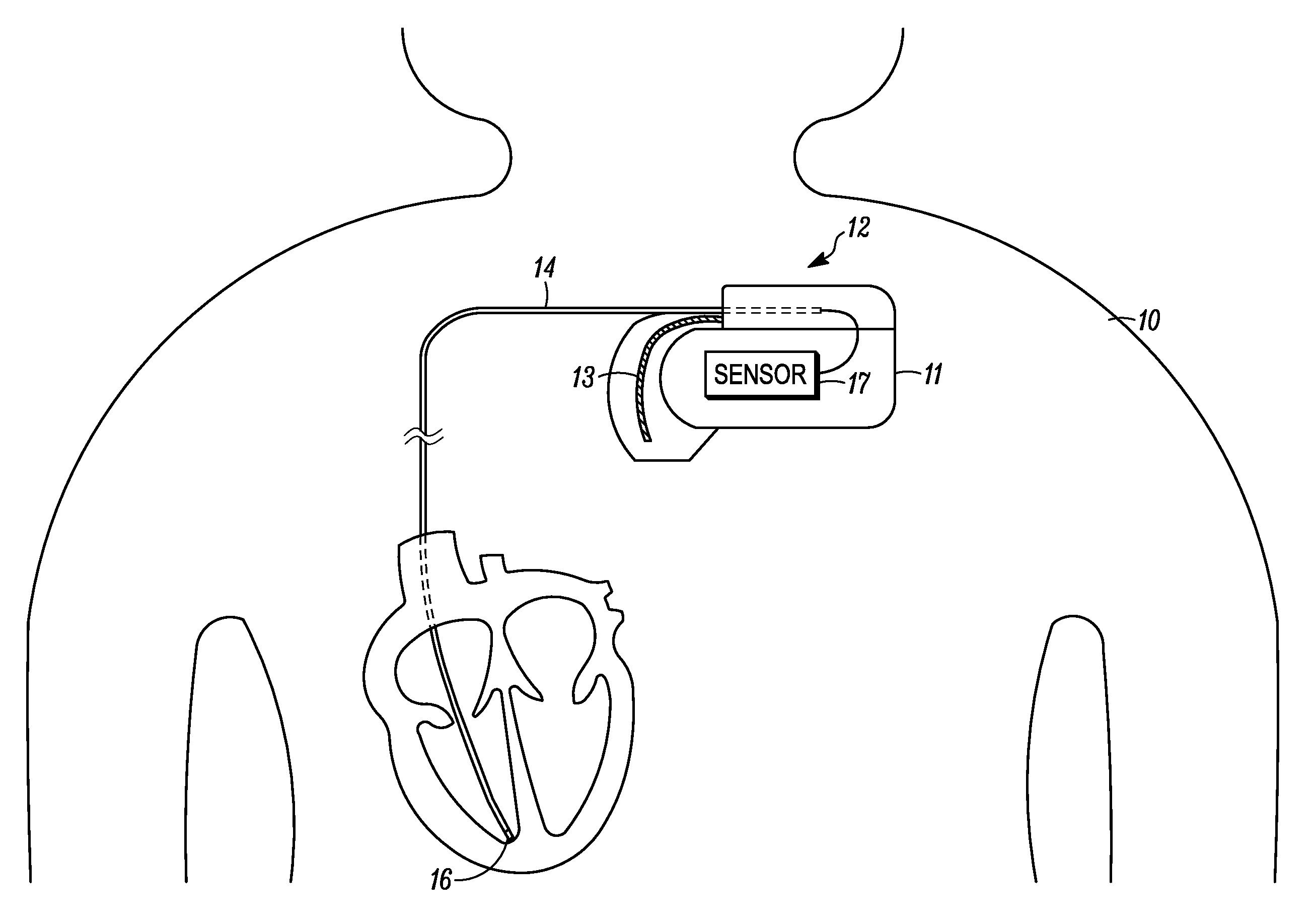 Implantable medical device with wireless communications