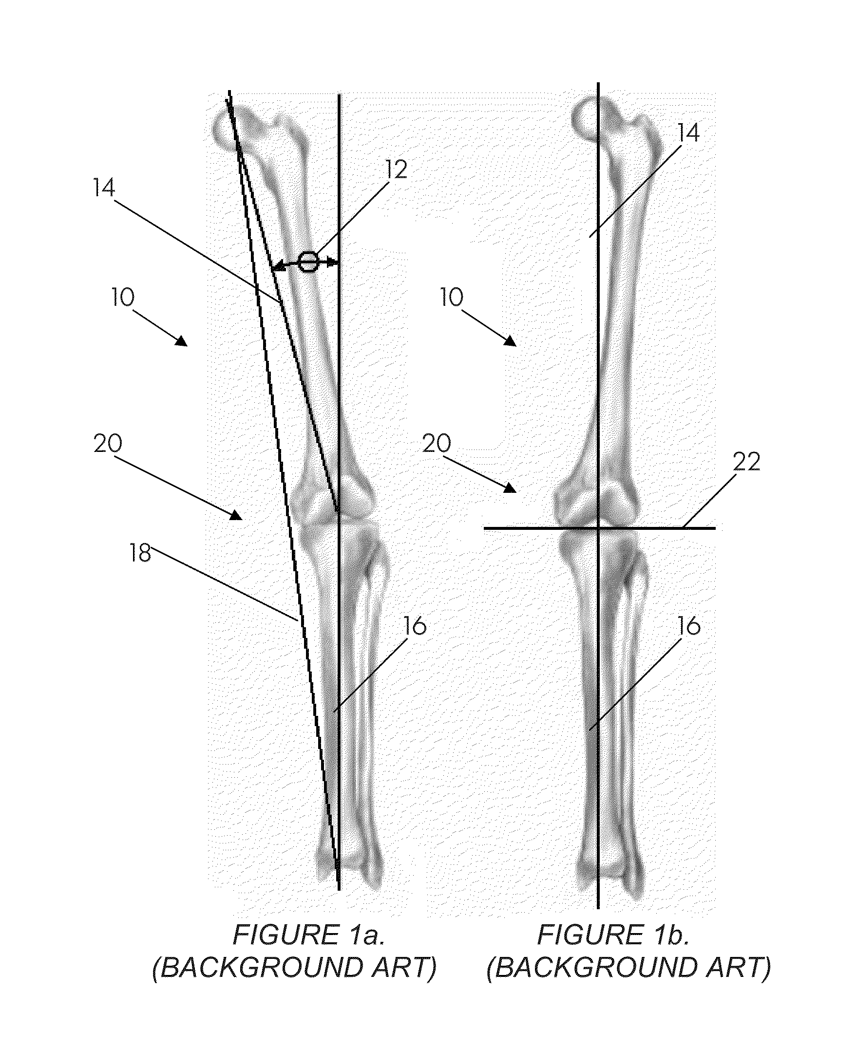 Systems and methods for determining the mechanical axis of a femur