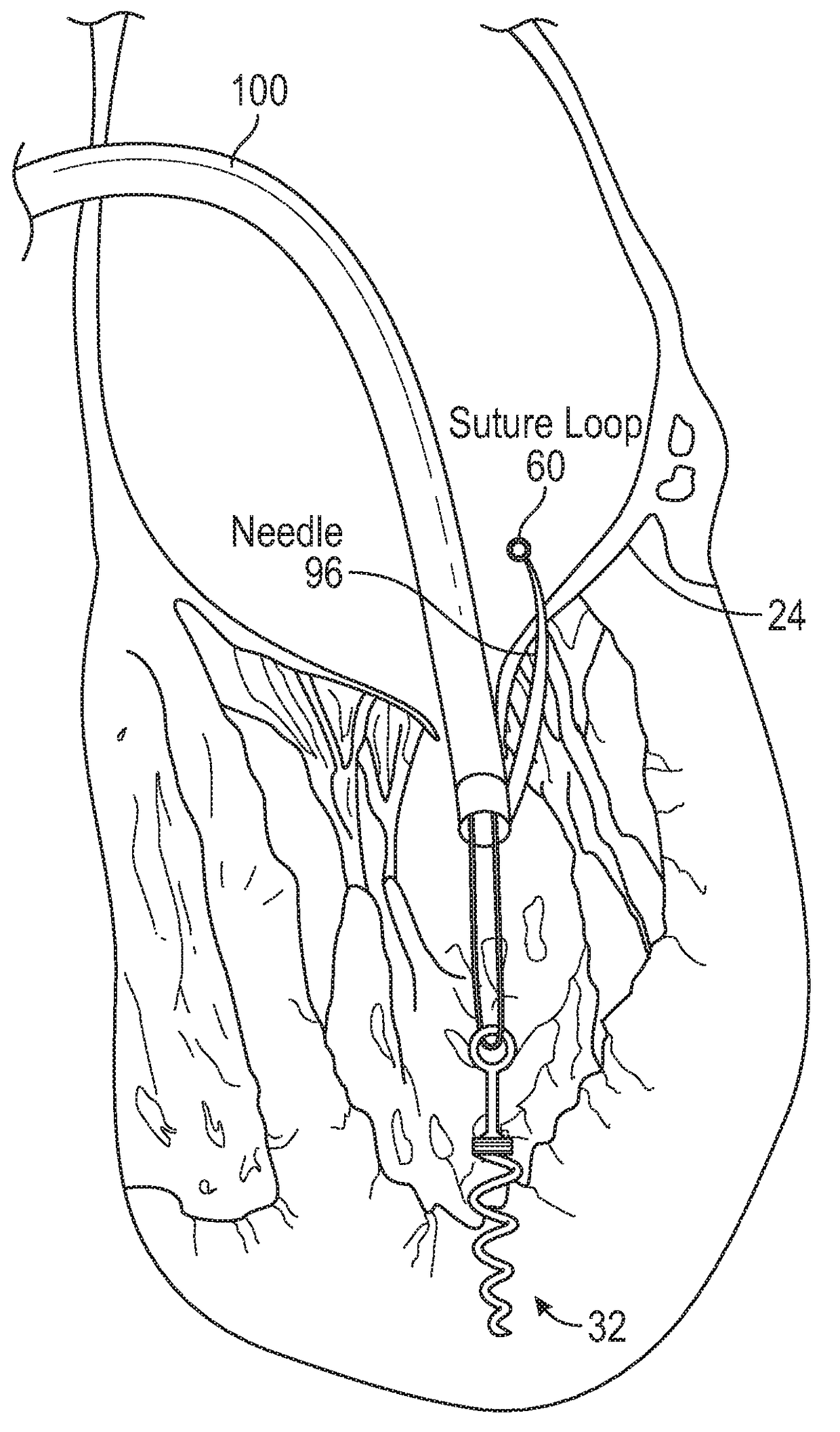 Method and apparatus for transvascular implantation of neo chordae tendinae