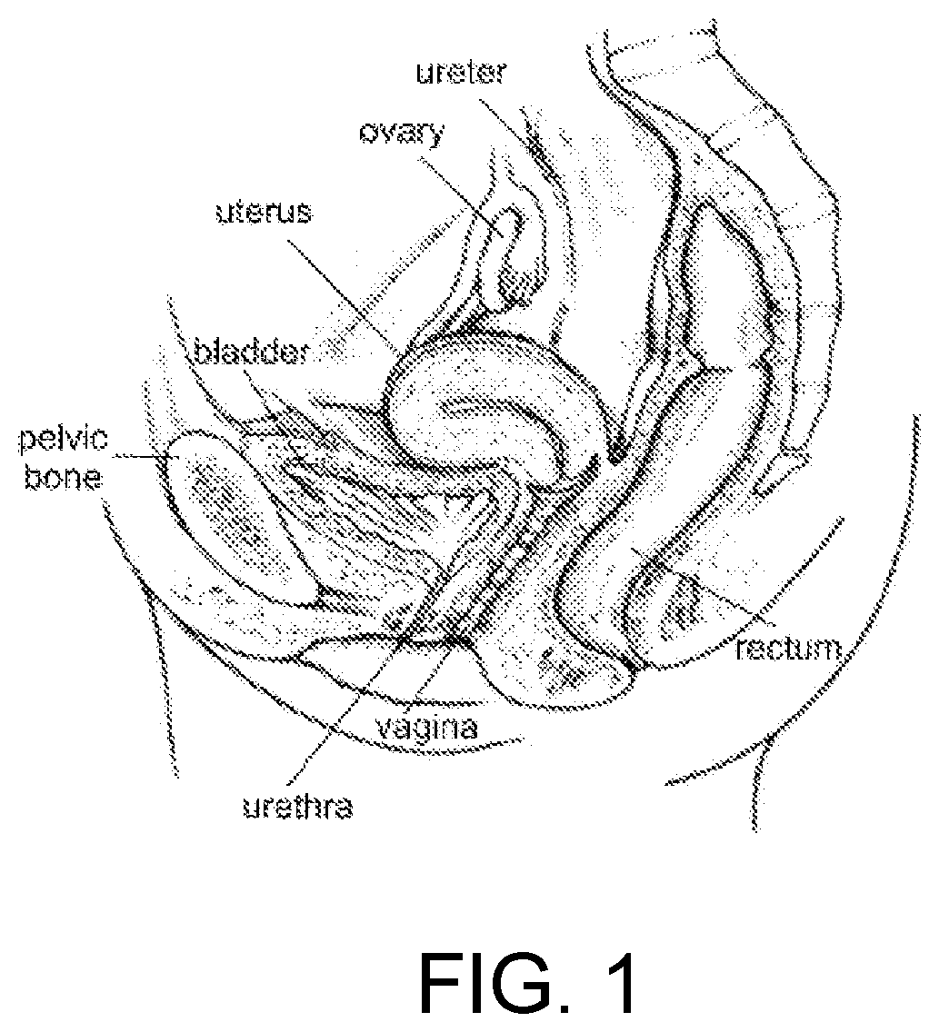 Device positionable in the uterine cavity and method of treatment thereof