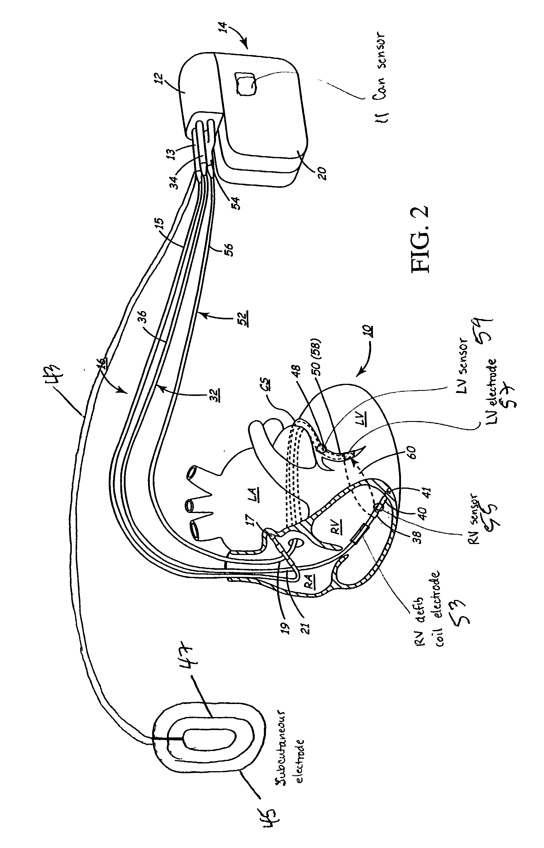 Implantable medical device for treating cardiac mechanical dysfunction by electrical stimulation