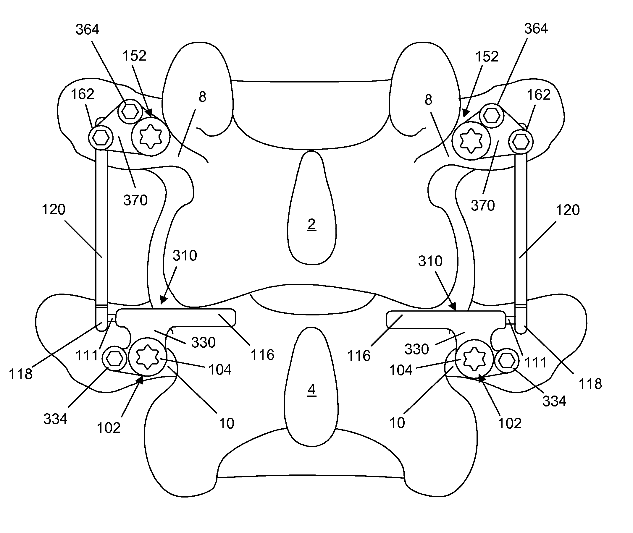 Spine implant with a deflection rod system and connecting linkages and method