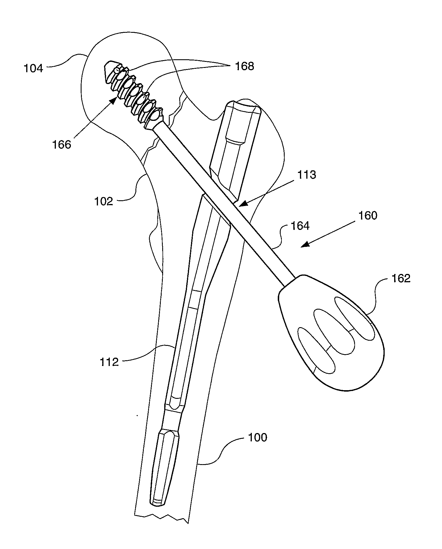 Methods and Instruments of Reducing a Fracture