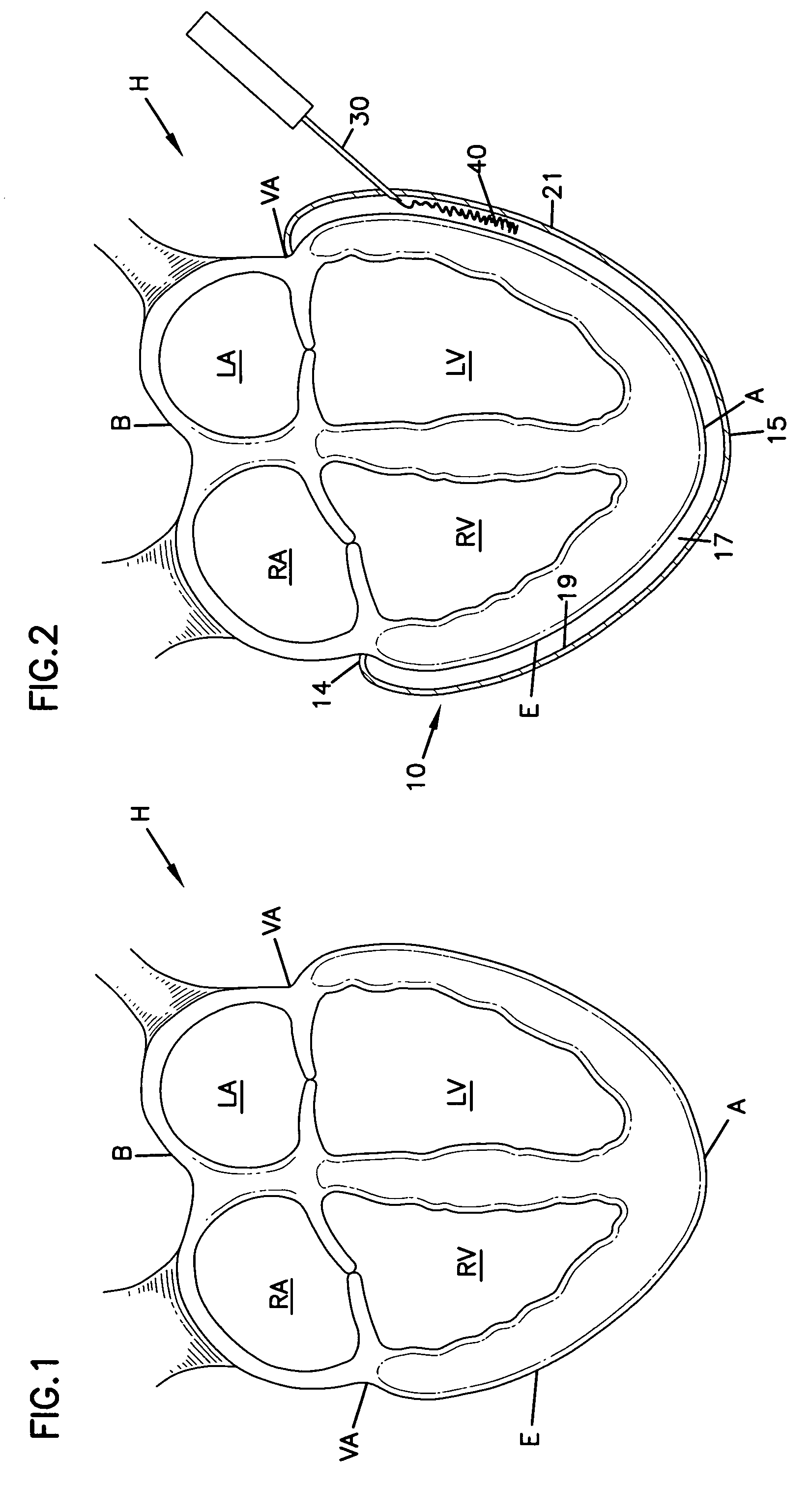 Cardiac wall tension relief device and method