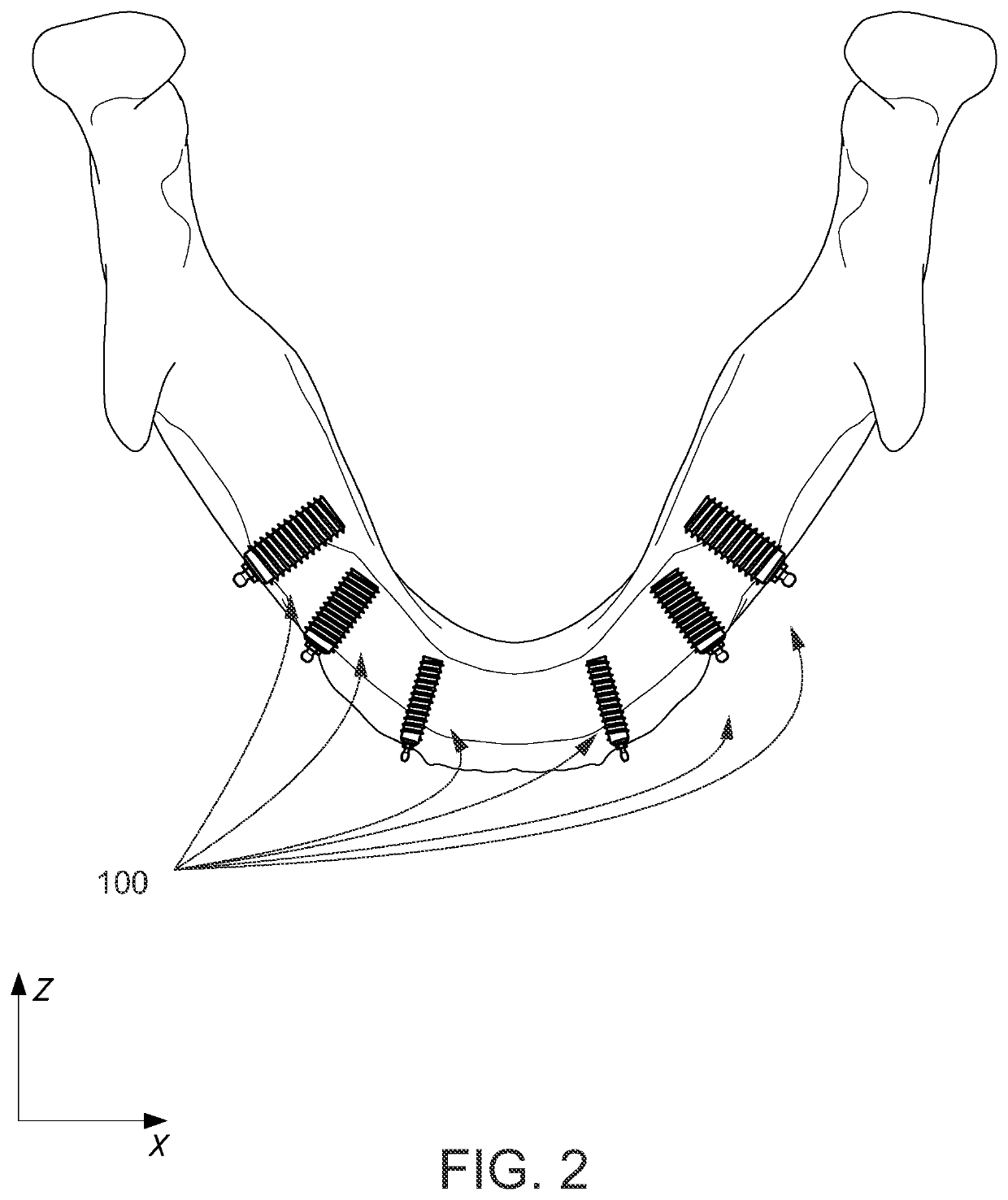 Endosteal horizontally placed dental implant system and method