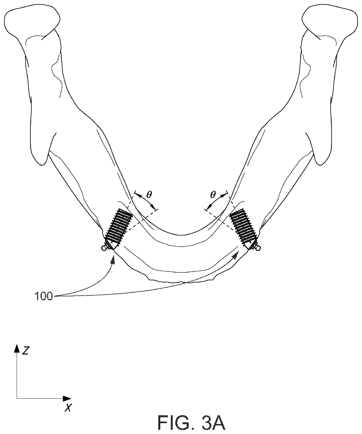 Endosteal horizontally placed dental implant system and method