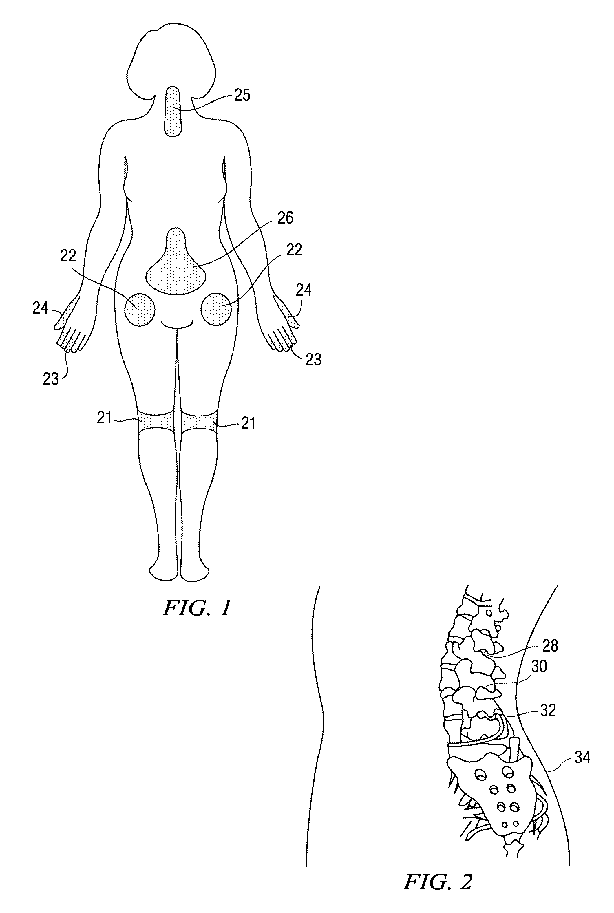 Methods and compositions for treating post-operative pain comprising a local anesthetic