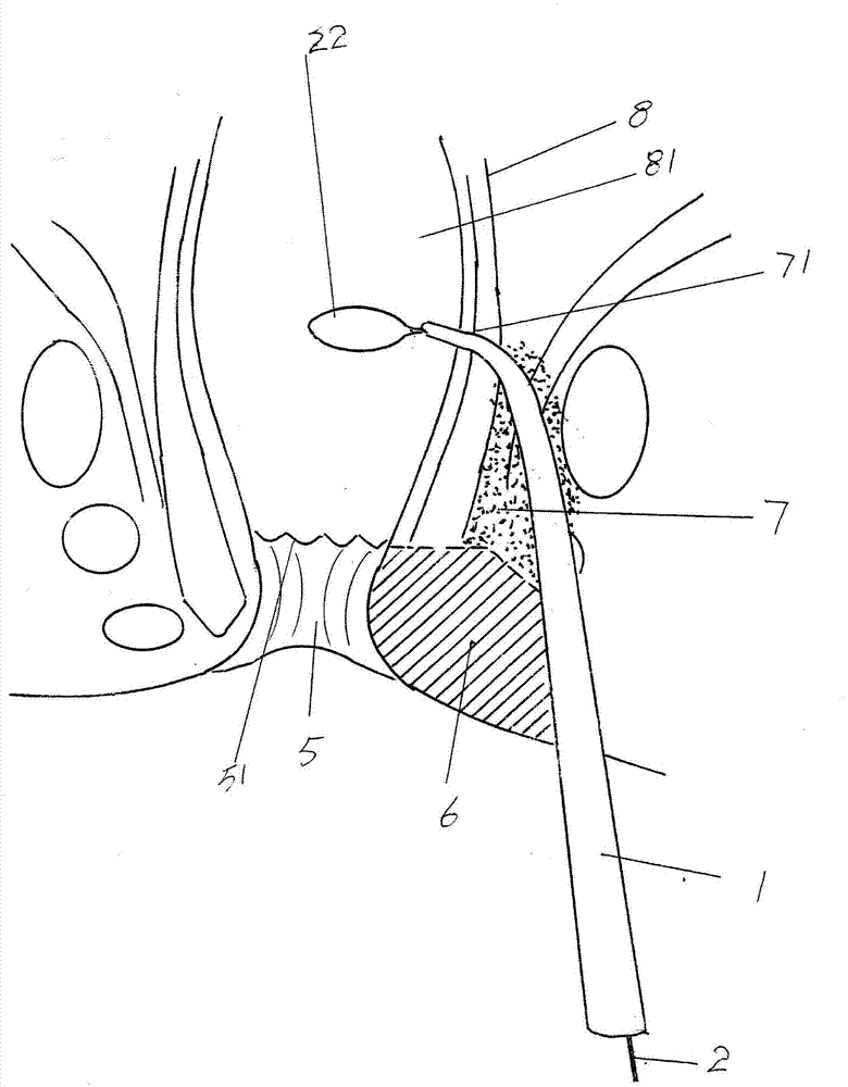 Anal fistula oriented seton stringing device