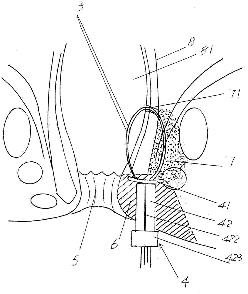 Anal fistula oriented seton stringing device