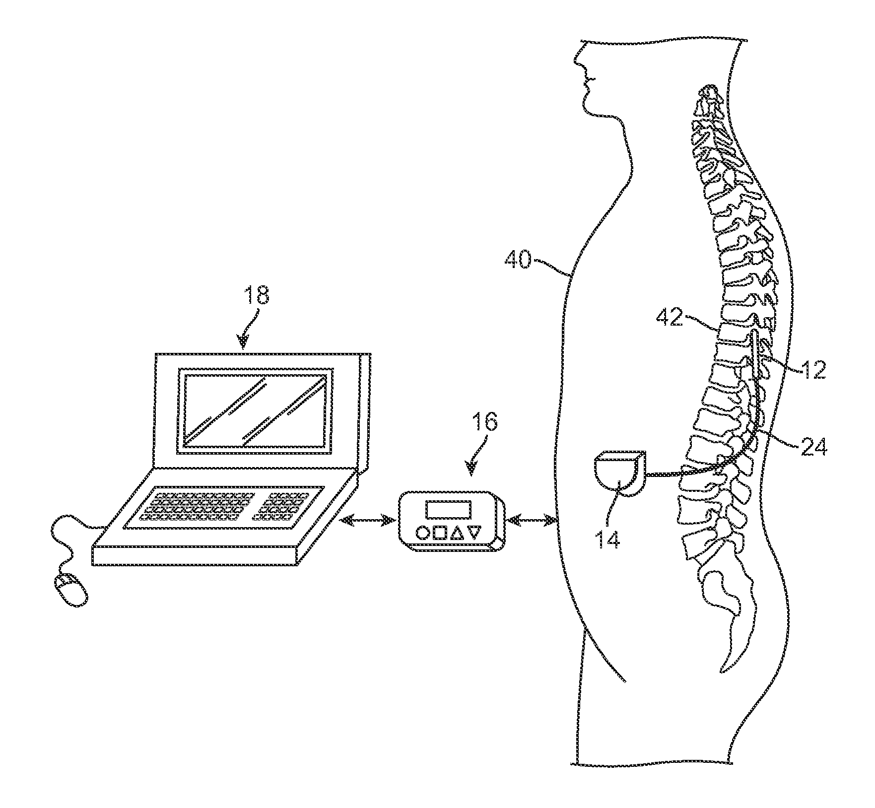 System and method for delivering modulated sub-threshold therapy to a patient