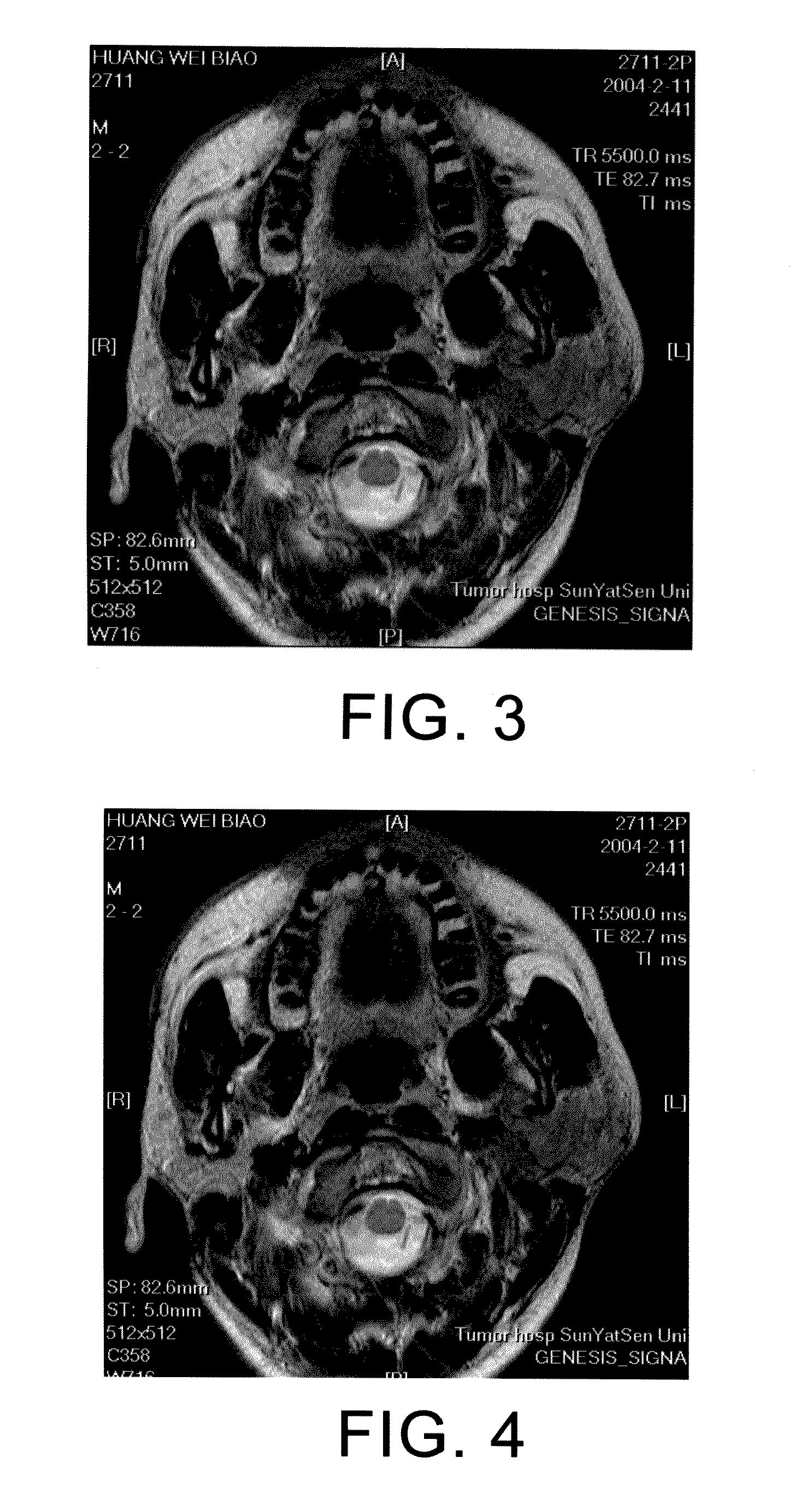 Method for culturing dendritic cells (DC) and cytokine-induced killer cells (D-CIK) and applications thereof