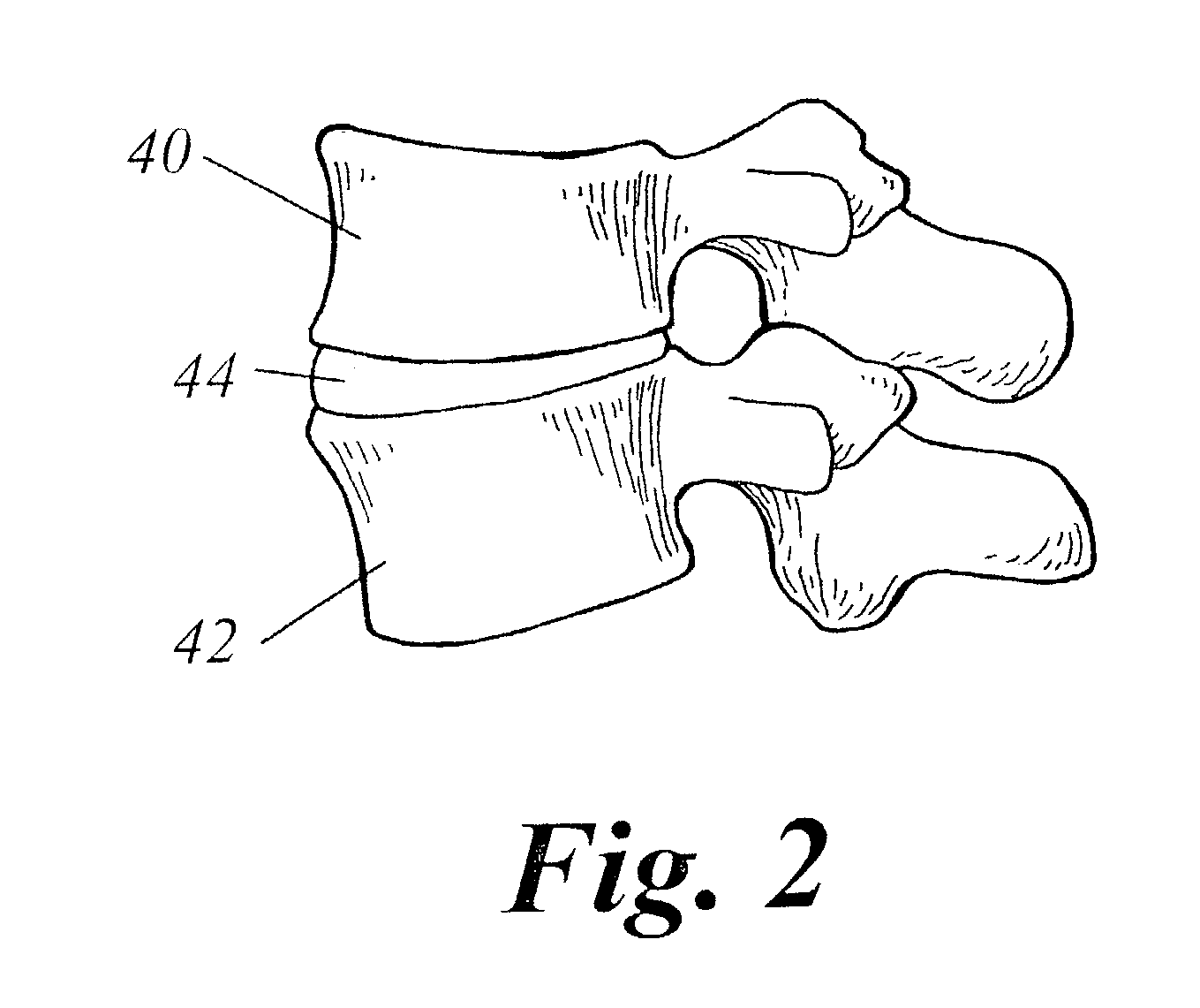 Spinal fusion using an HMG-CoA reductase inhibitor