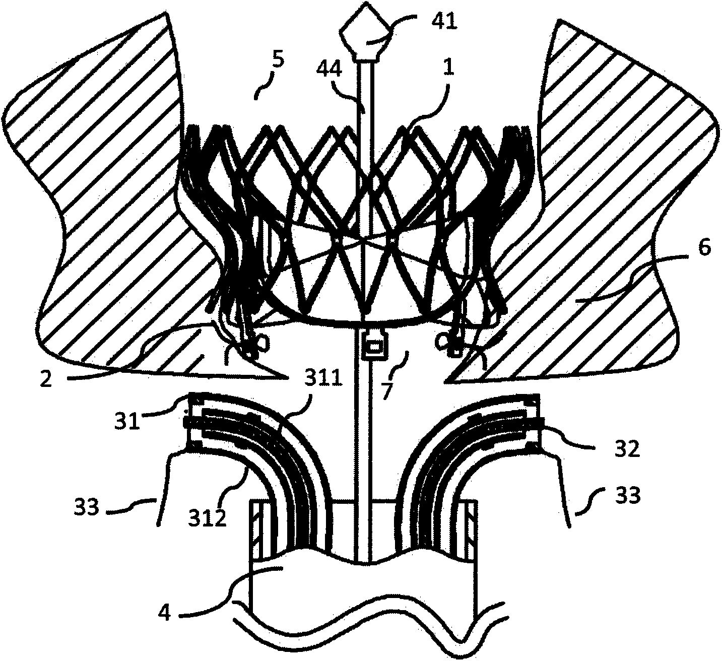 Heart valve implantation device provided with anchoring device