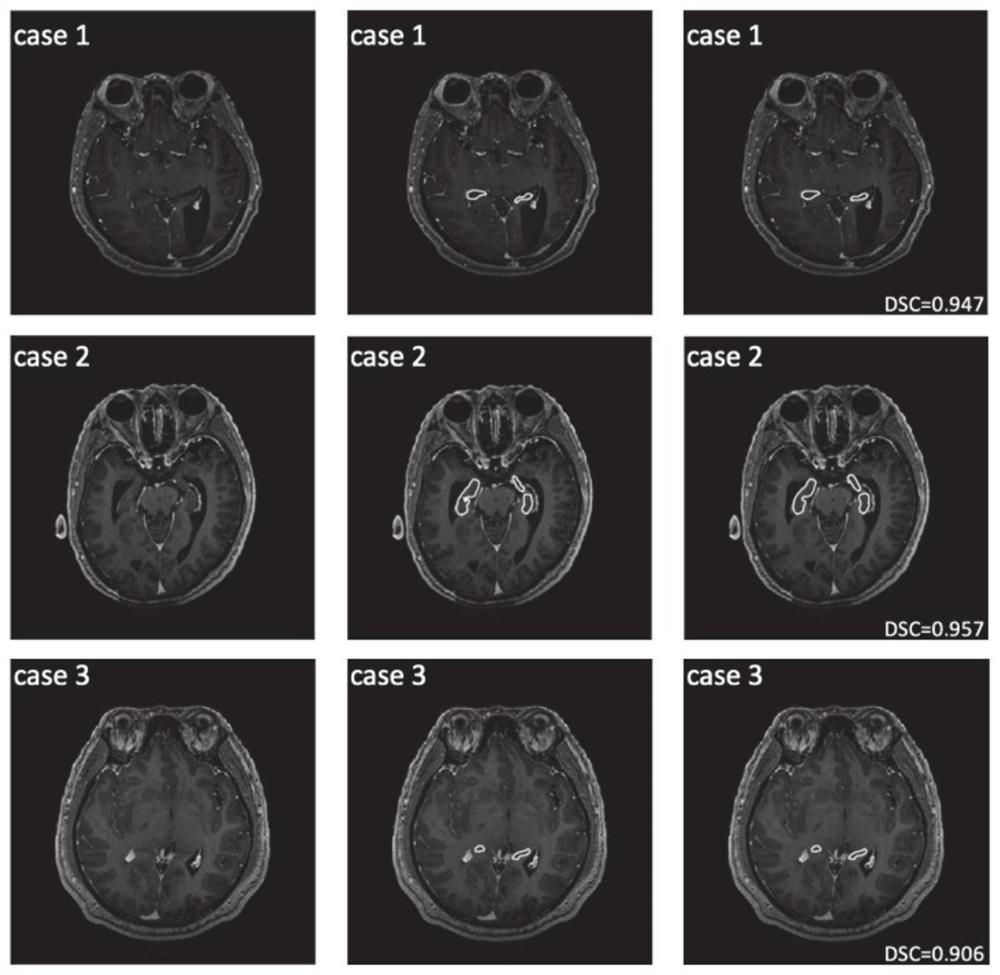 MRI (Magnetic Resonance Imaging) hippocampus segmentation method and system based on hypergraph numerical neural membrane system