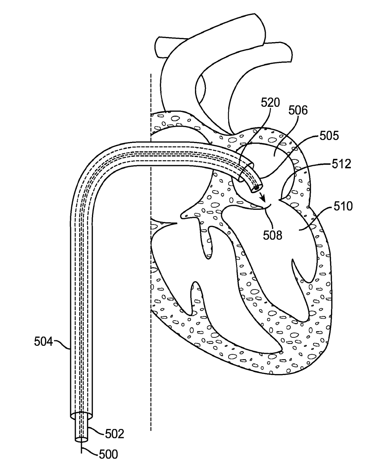 Percutaneous or Minimally Invasive Cardiac Valve Repair System and Methods of Using the Same