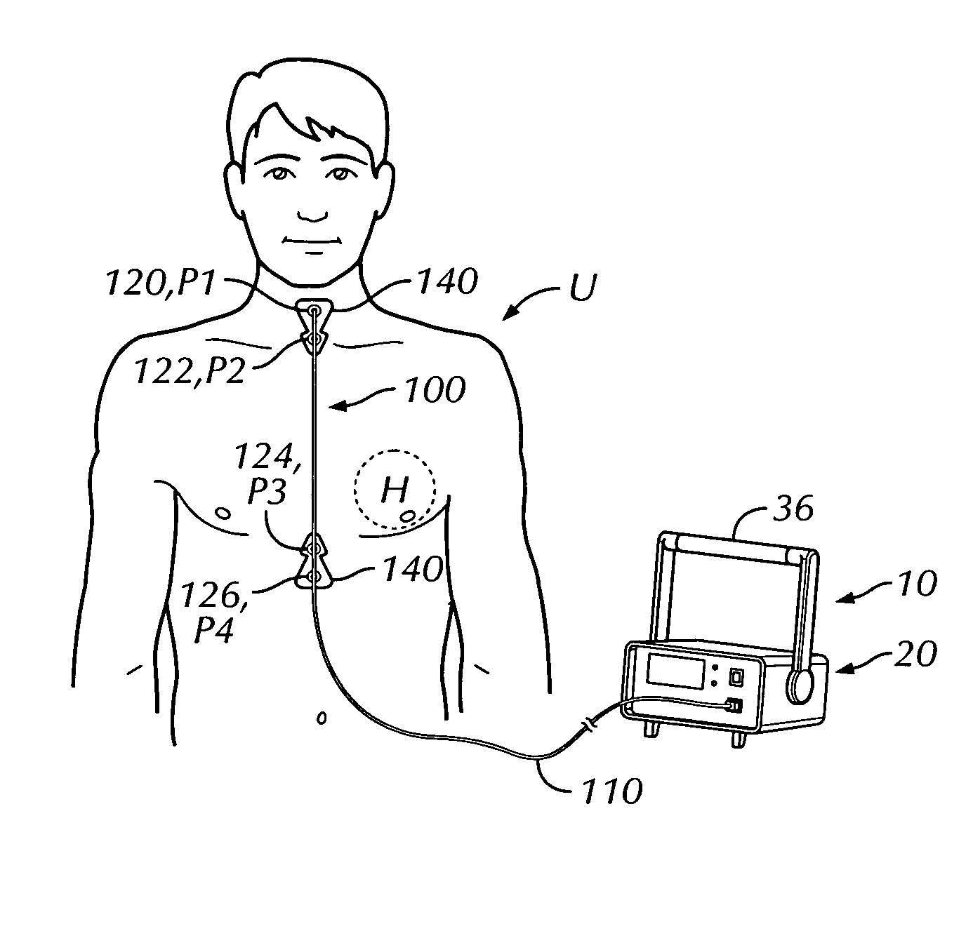 Thoracic impedance monitor and electrode array and method of use