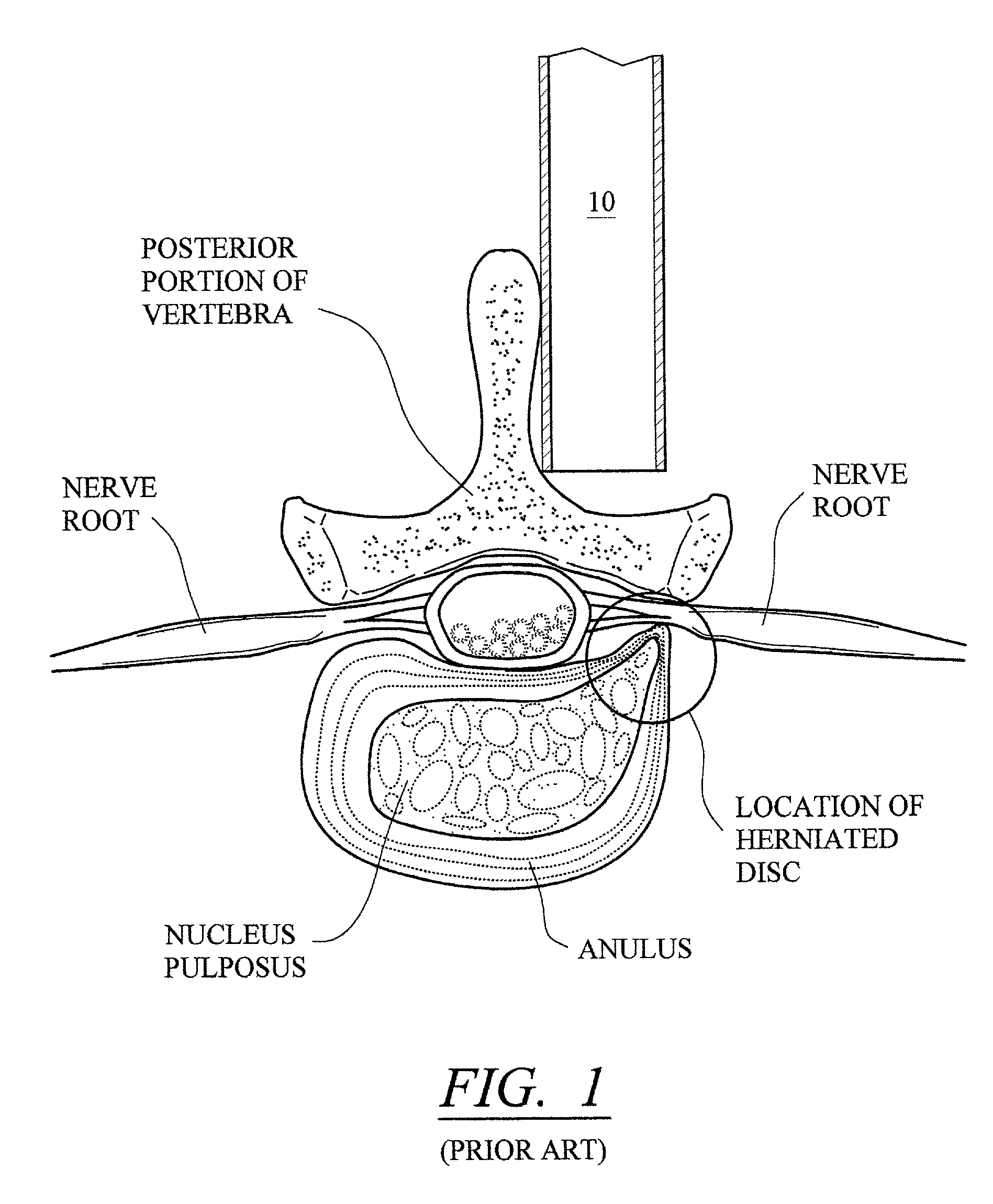 Configured and sized cannula