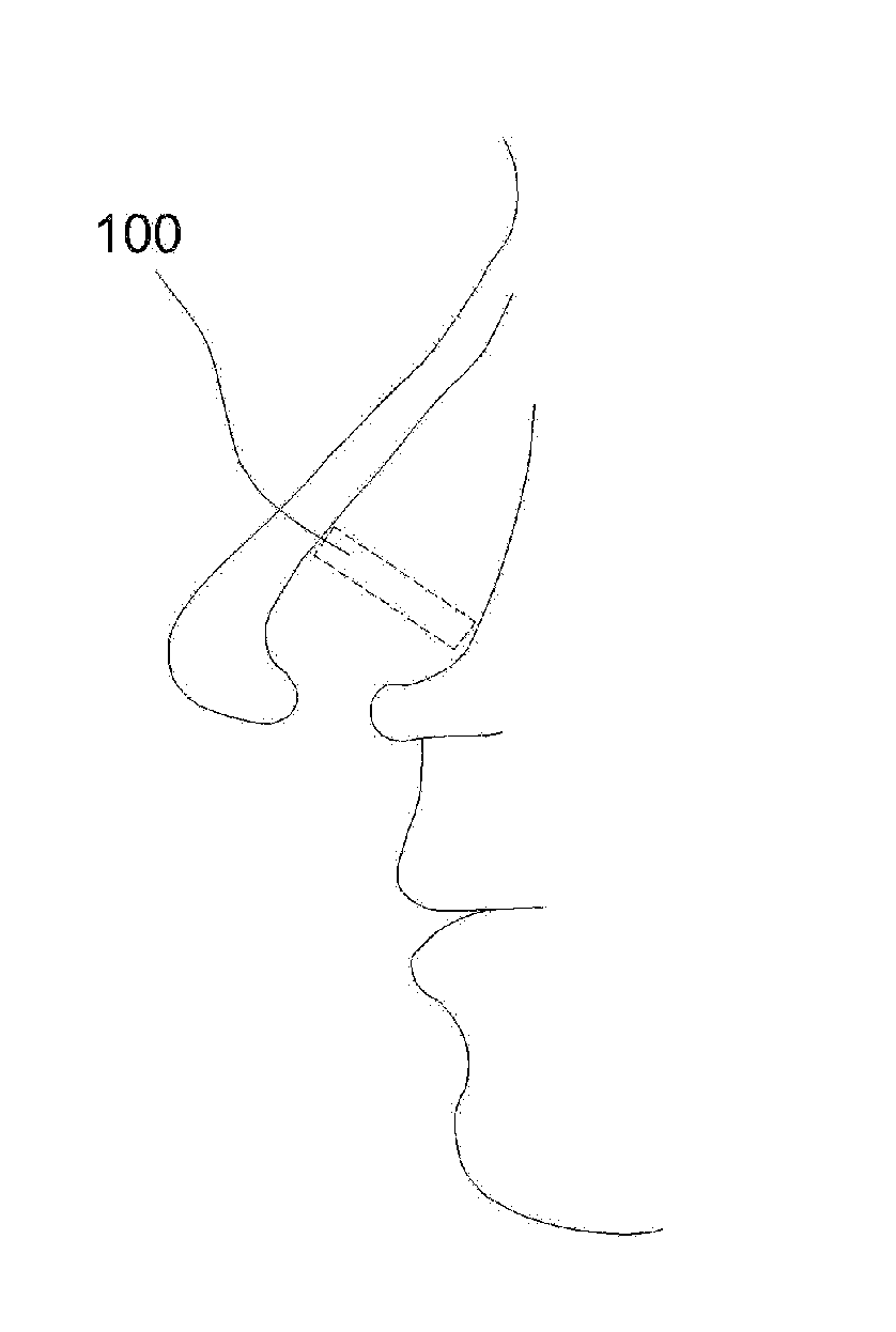 Nasal implant for correction