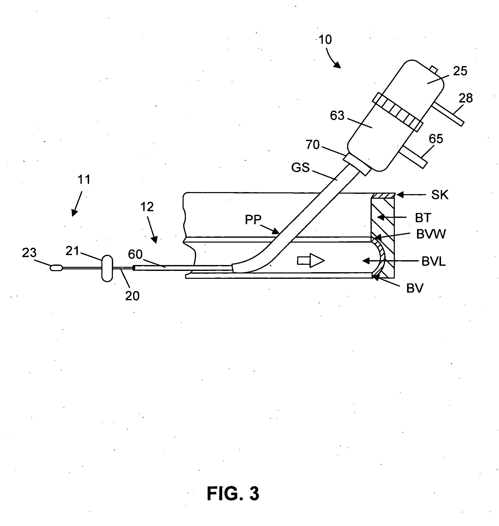 Method and system for sealing percutaneous punctures