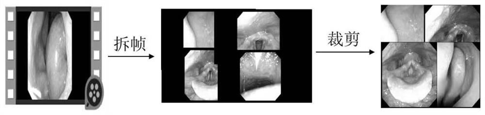 Electronic laryngoscope image classification method based on binuclear convolution feature extraction