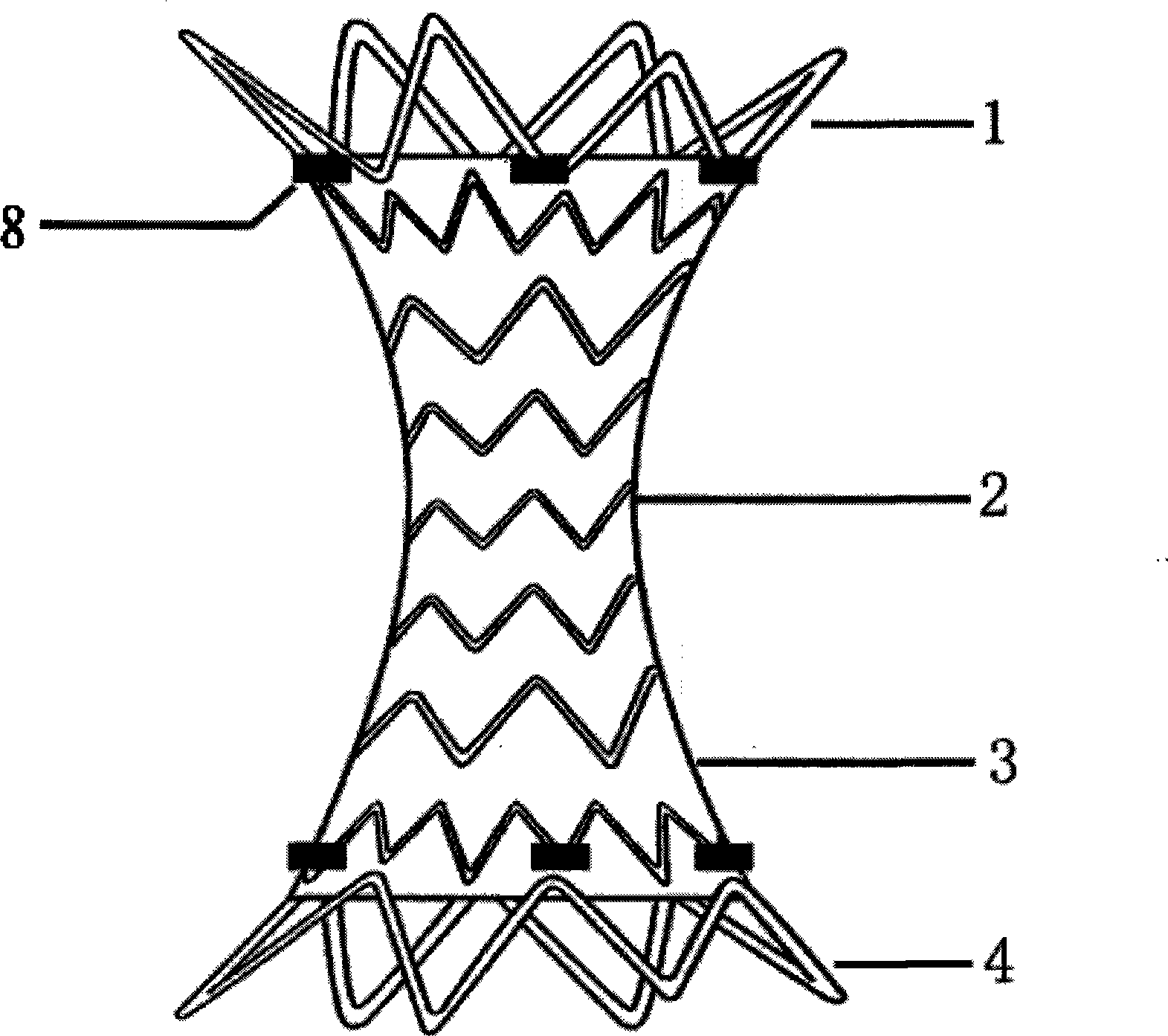 Pulmonary artery coarctation bracket for pulmonary hypertension surgery treatment