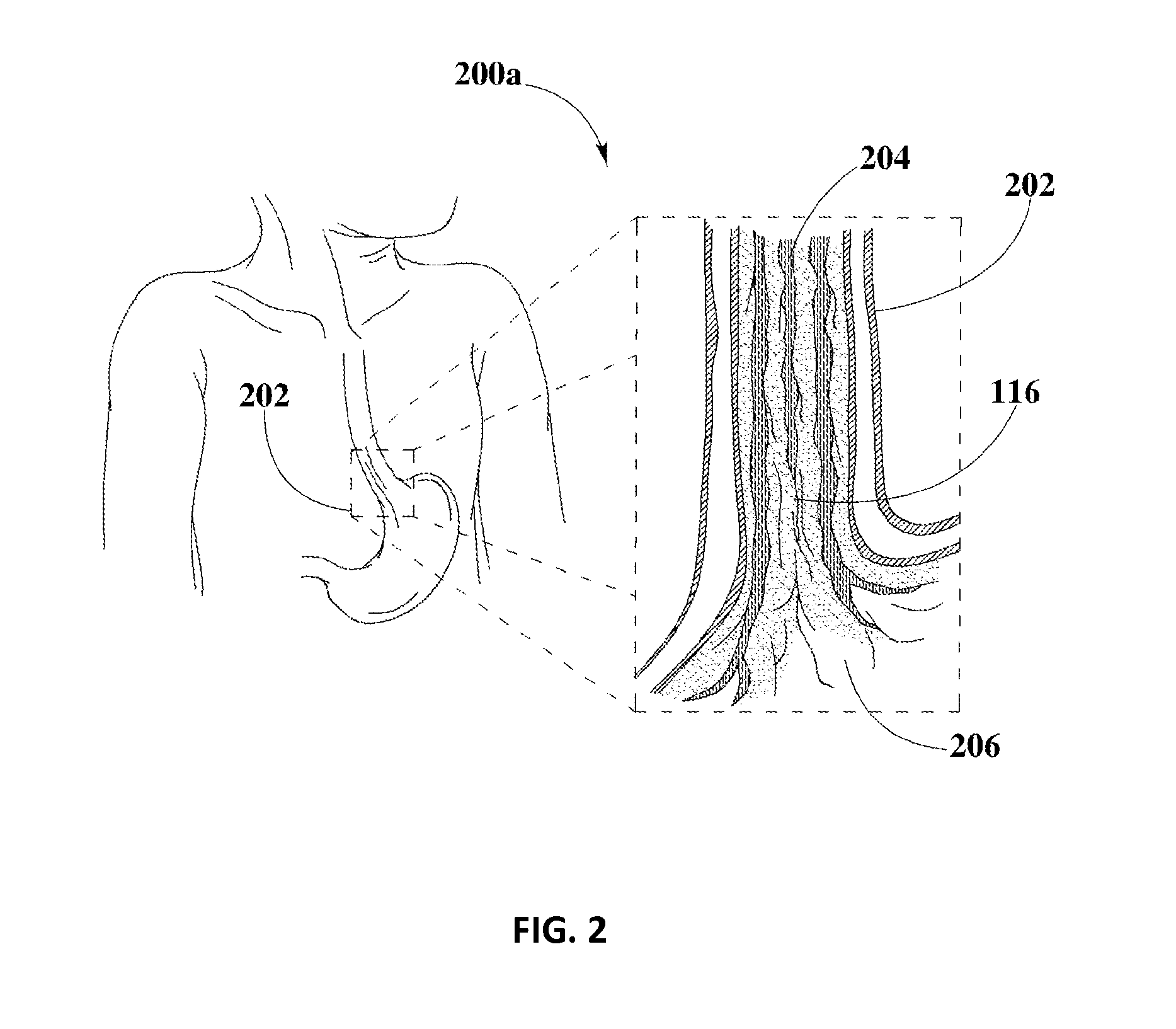 Methods and Compositions for Treating Esophageal Diseases