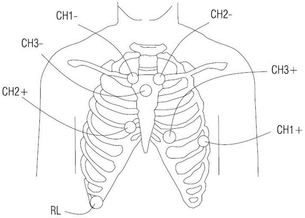 A Three-Lead ECG Monitoring System with Electrode Connection Discrimination Function