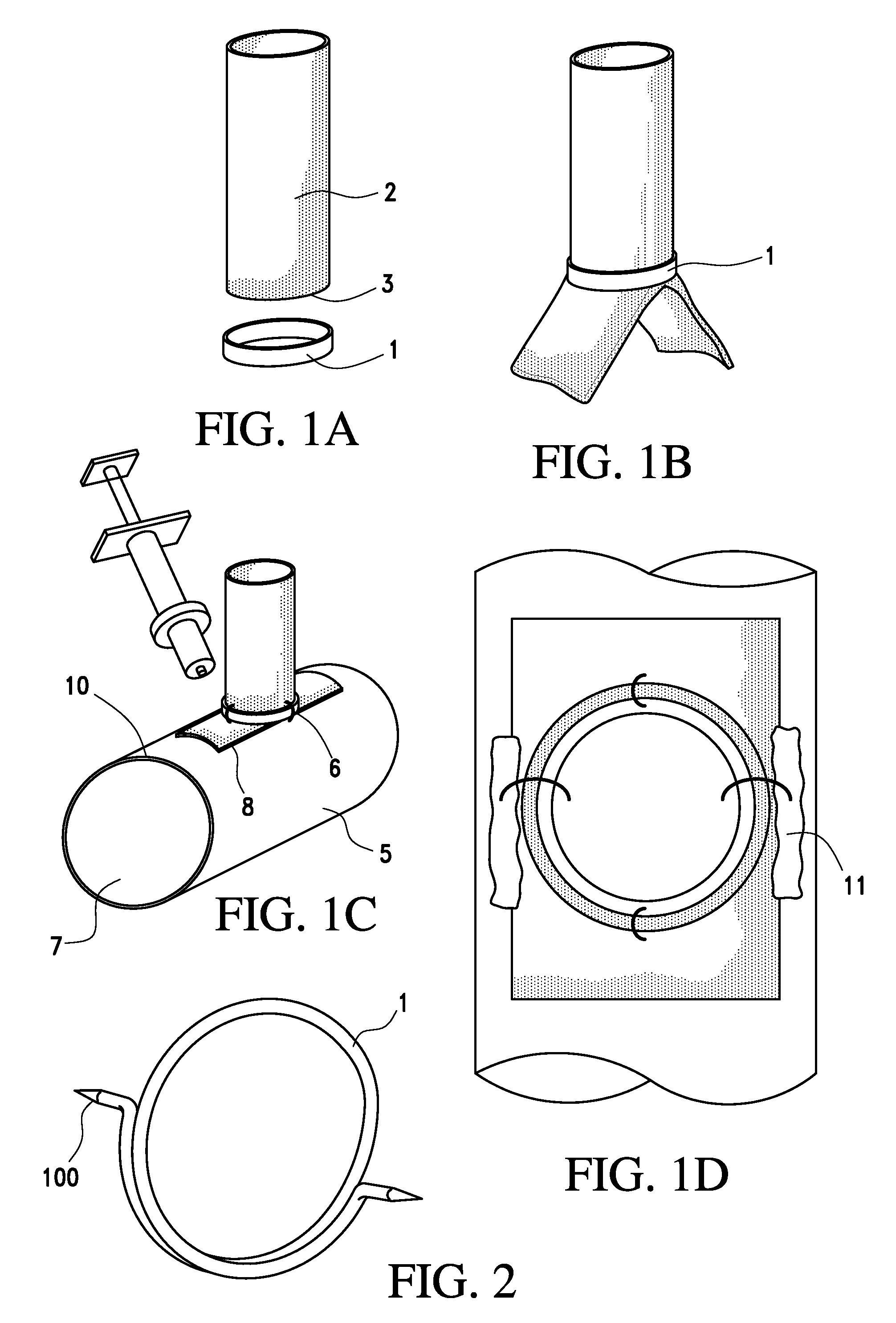 Device and method for joining vessels in anastomosis