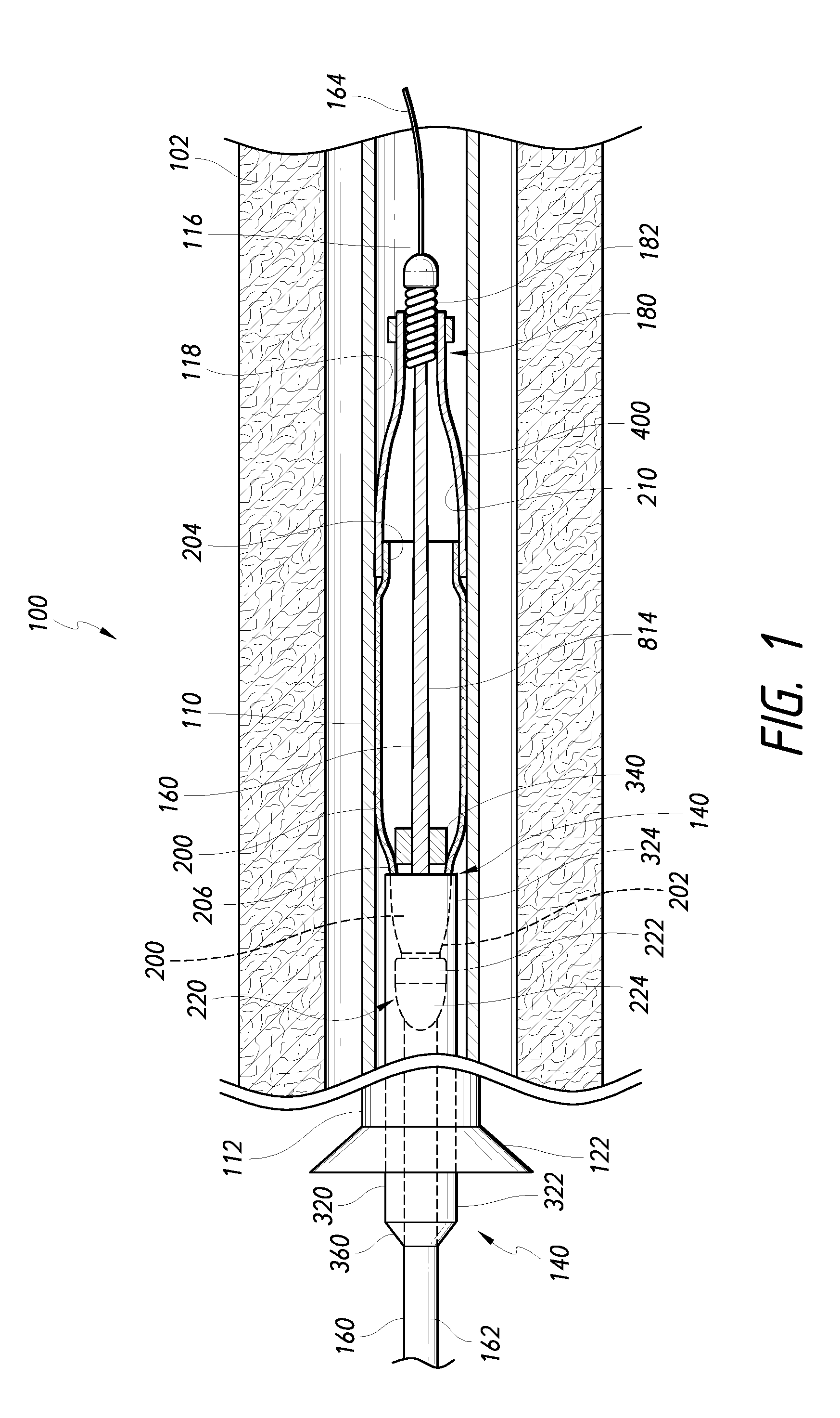 Methods and apparatus for luminal stenting