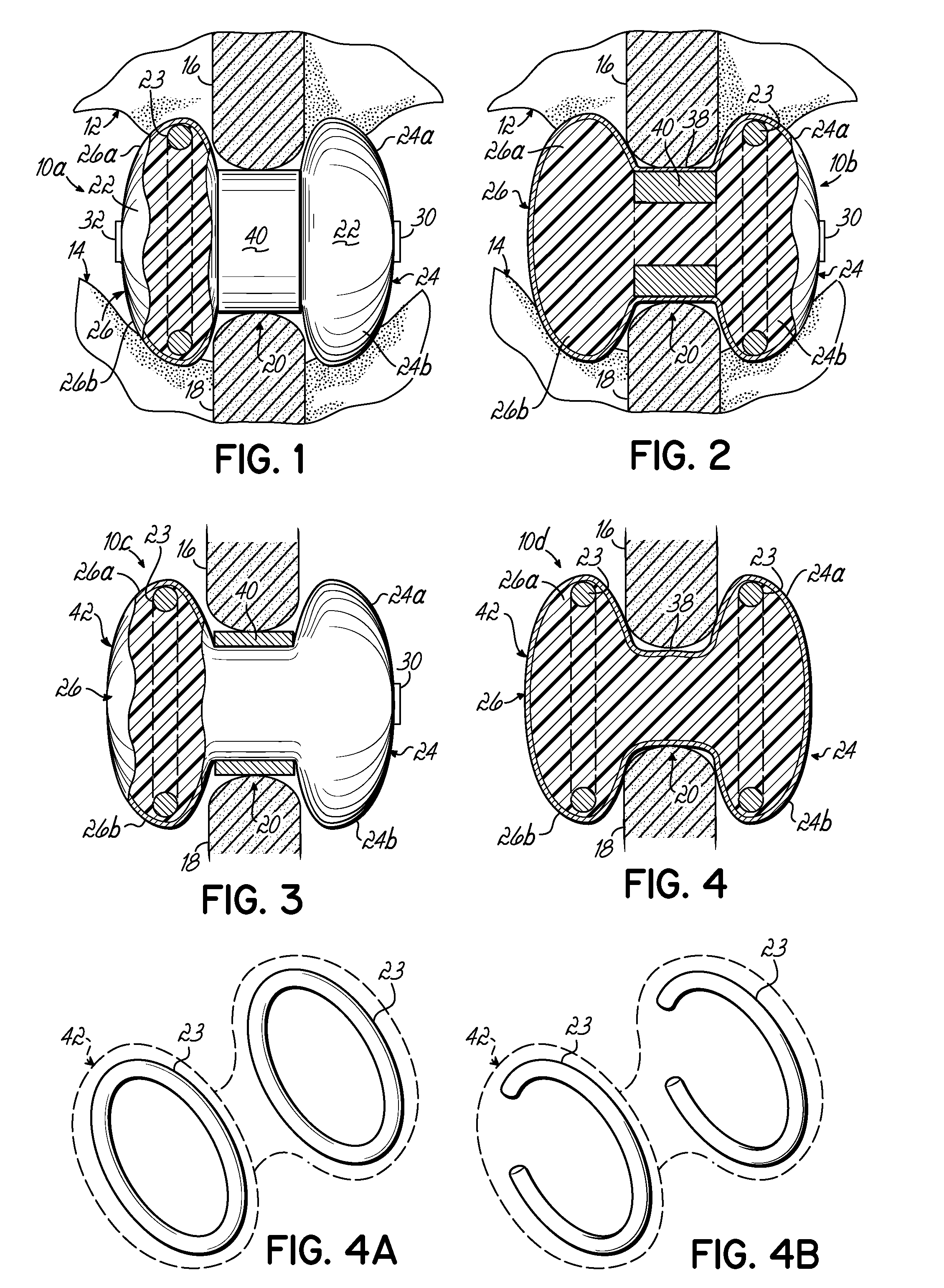 Expandable interspinous process spacer with lateral support and method for implantation