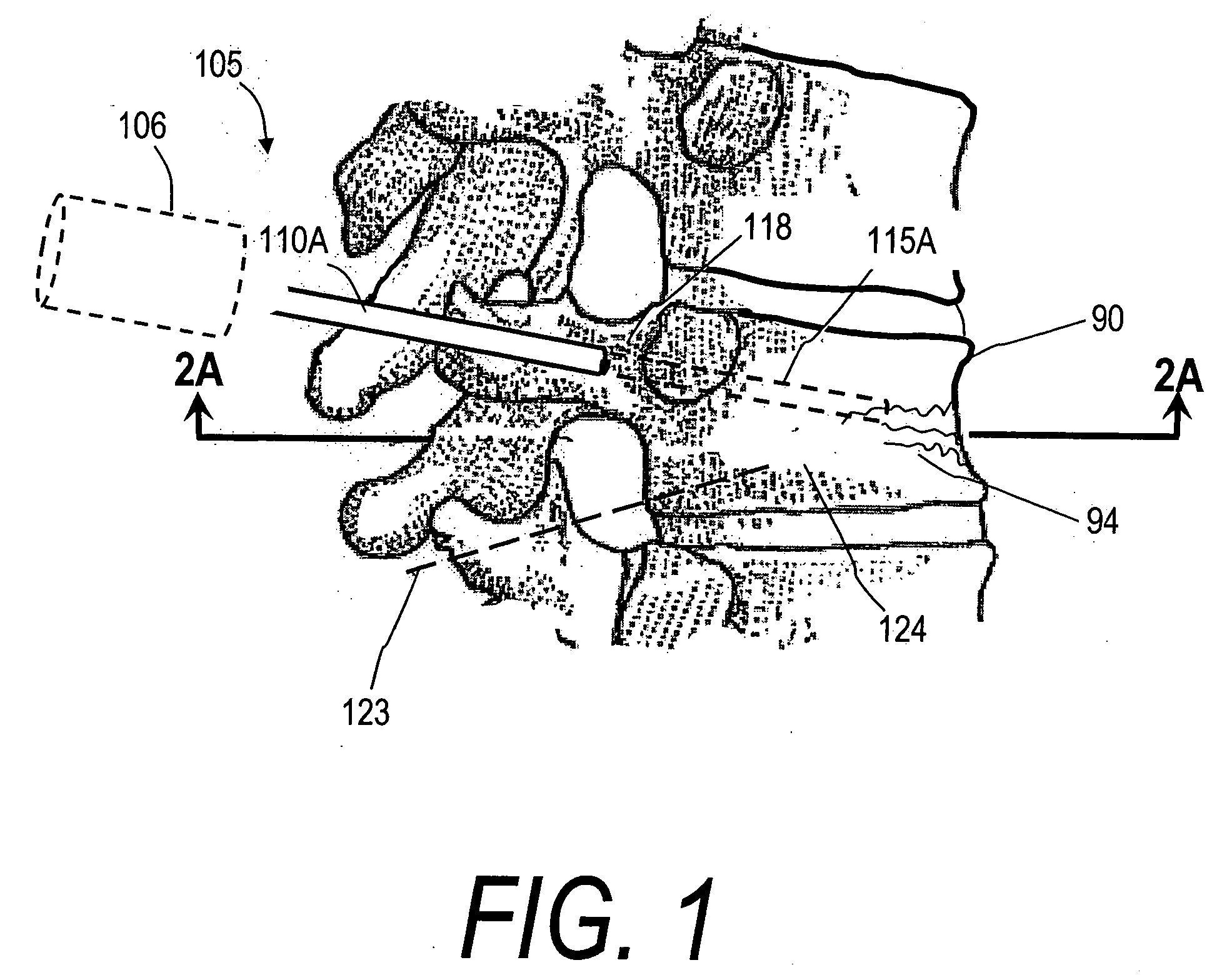 Bone treatment systems and methods