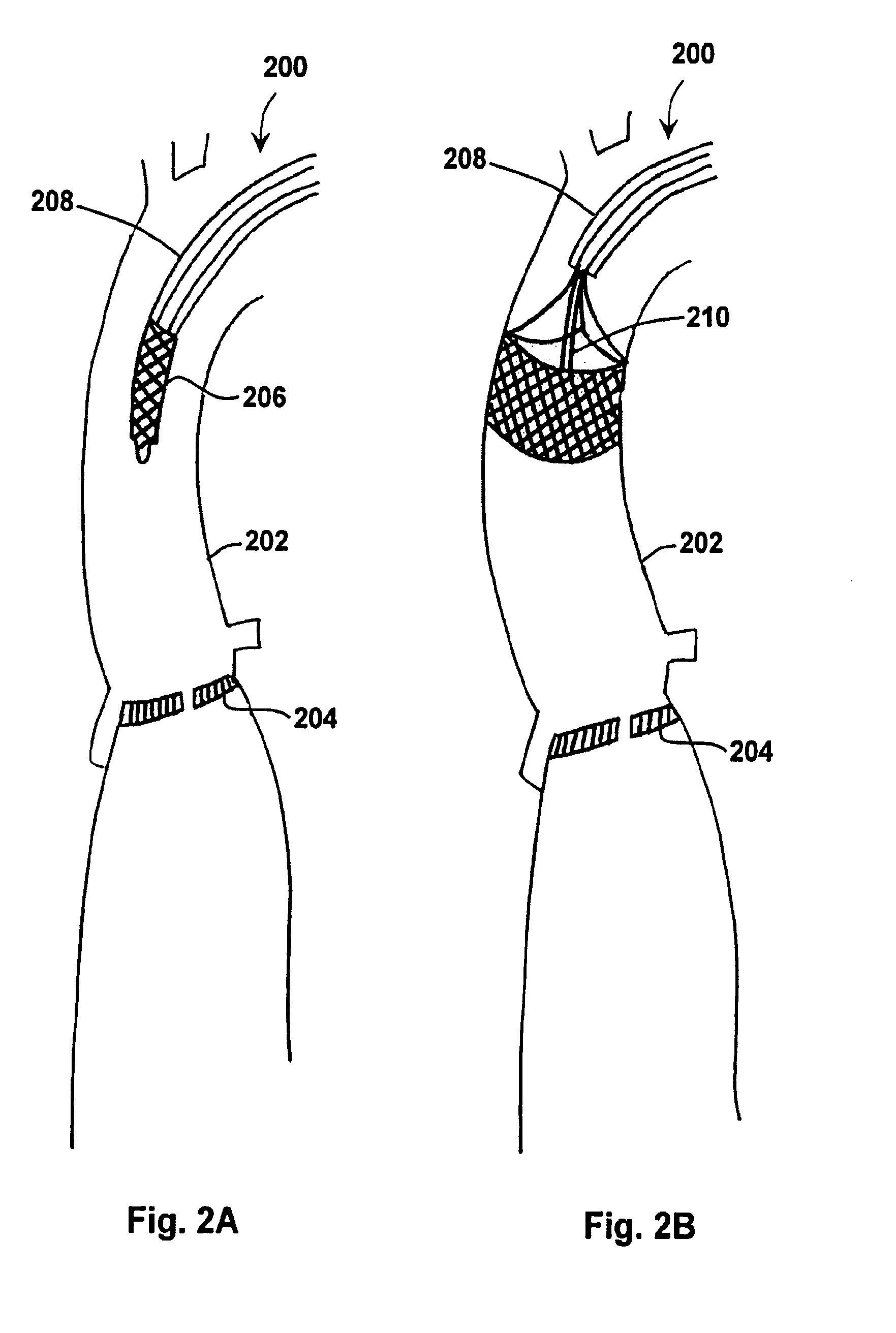 Devices, systems, and methods for valve removal