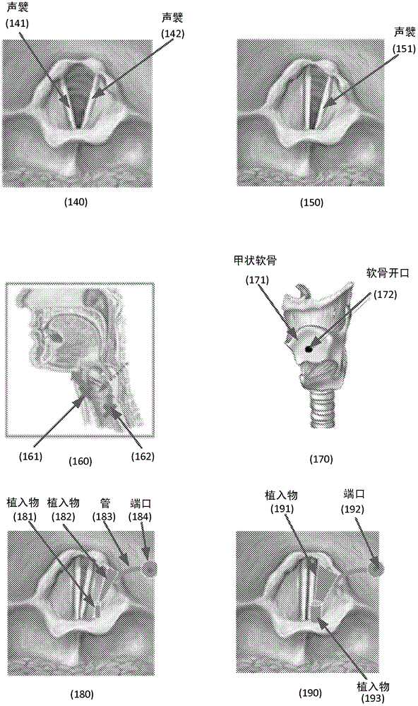 Methods and apparatus for treating glottic insufficiency