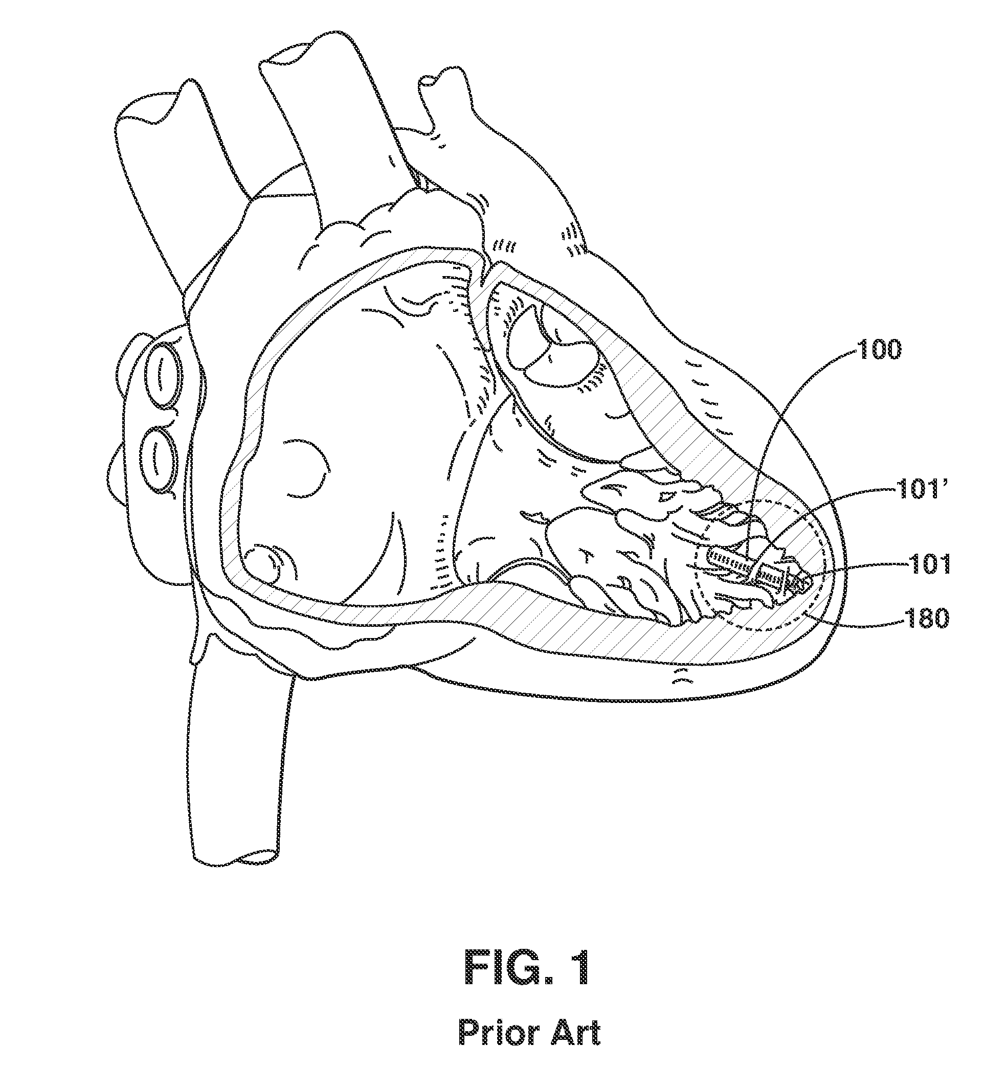 Two-Stage Delivery Systems and Methods for Fixing a Leadless Implant to Tissue