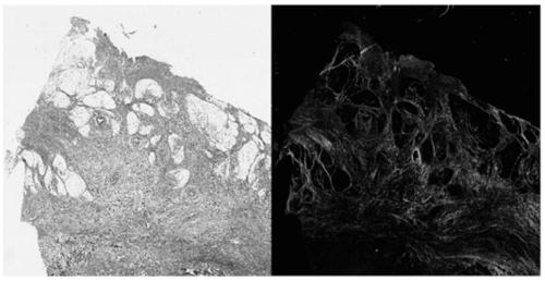Evaluation Method of Collagen Tissue on Gastric Serosa Surface in Resected Specimens of Gastric Cancer