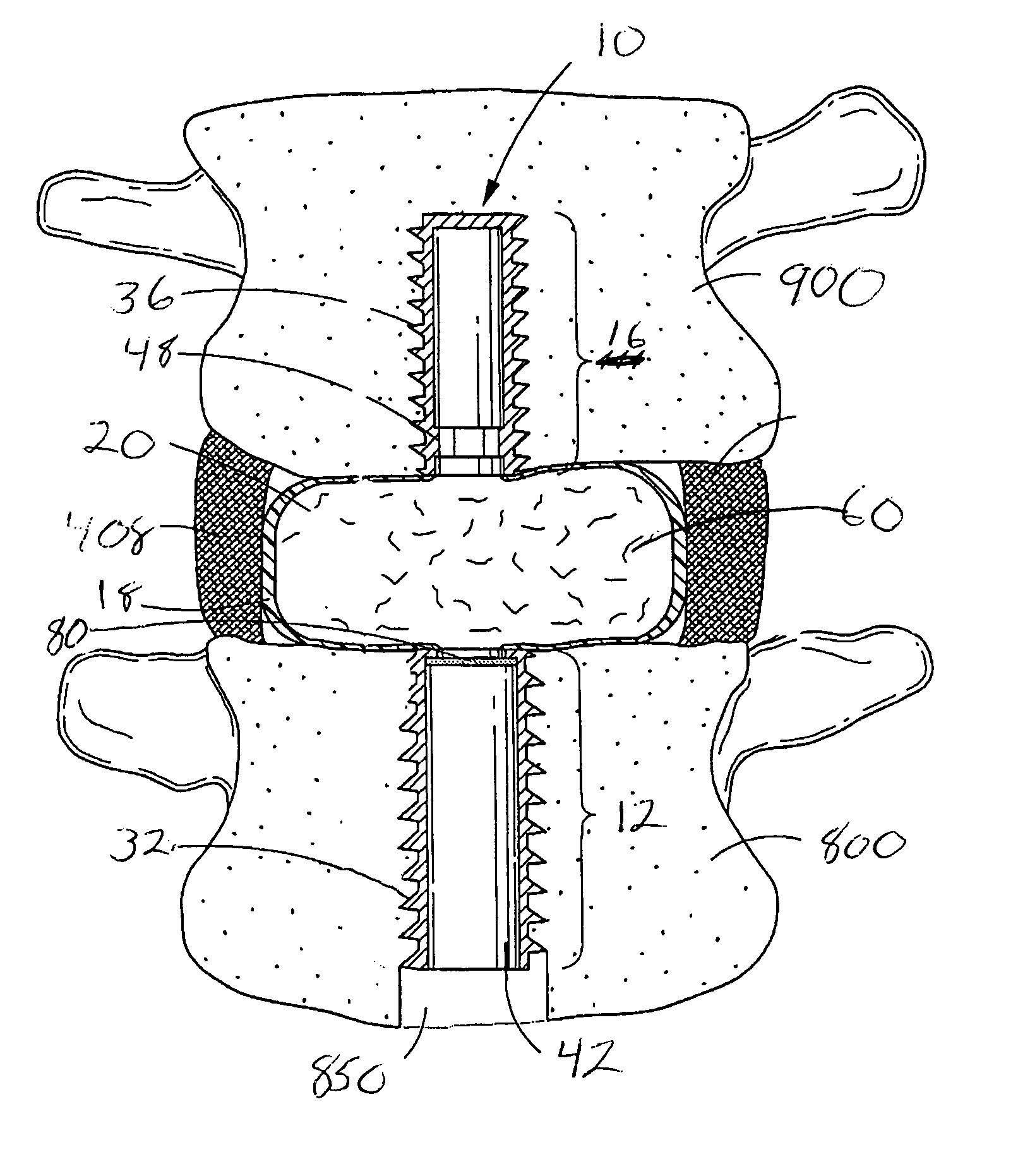 Spinal mobility preservation apparatus