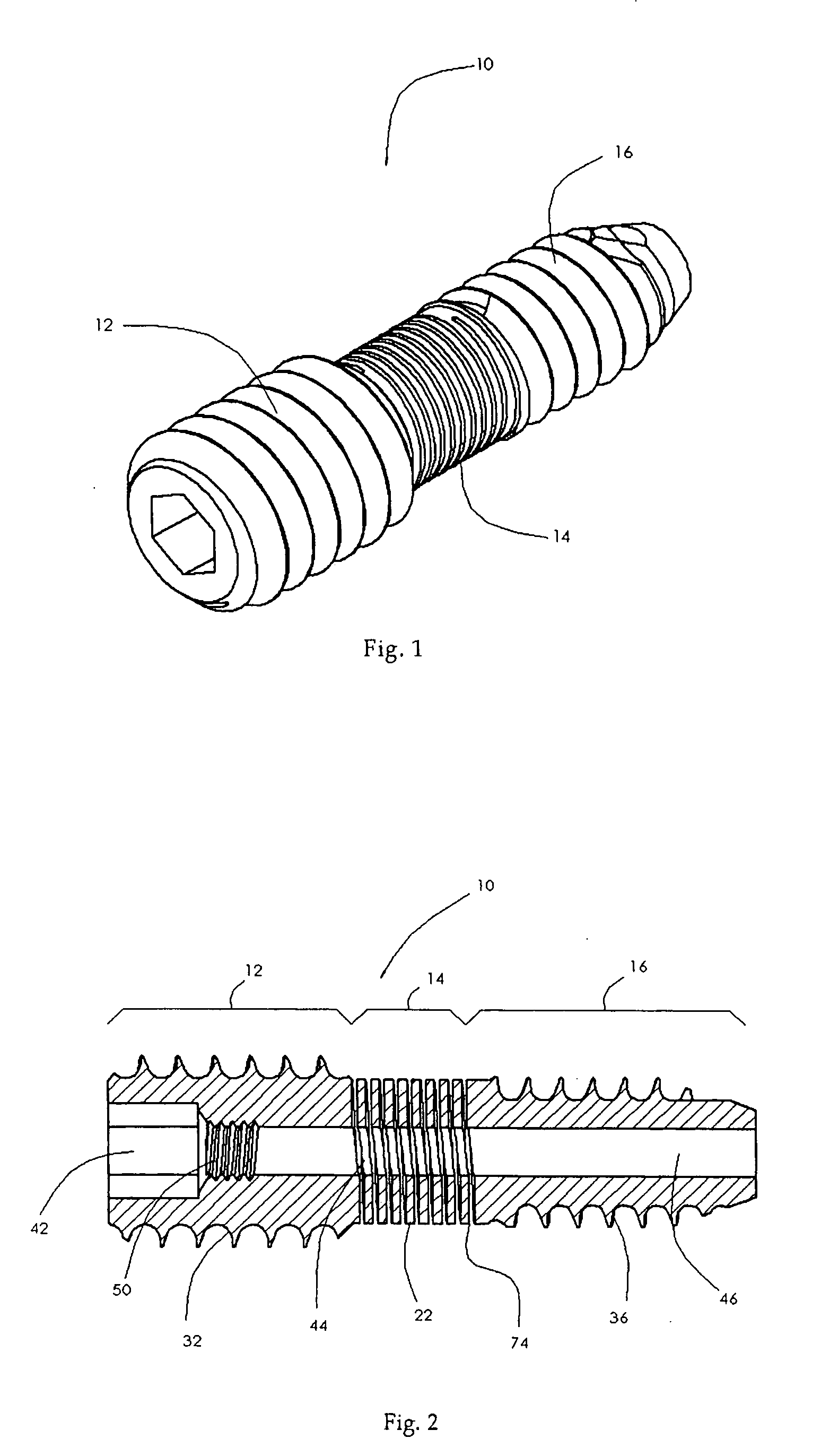Spinal mobility preservation apparatus