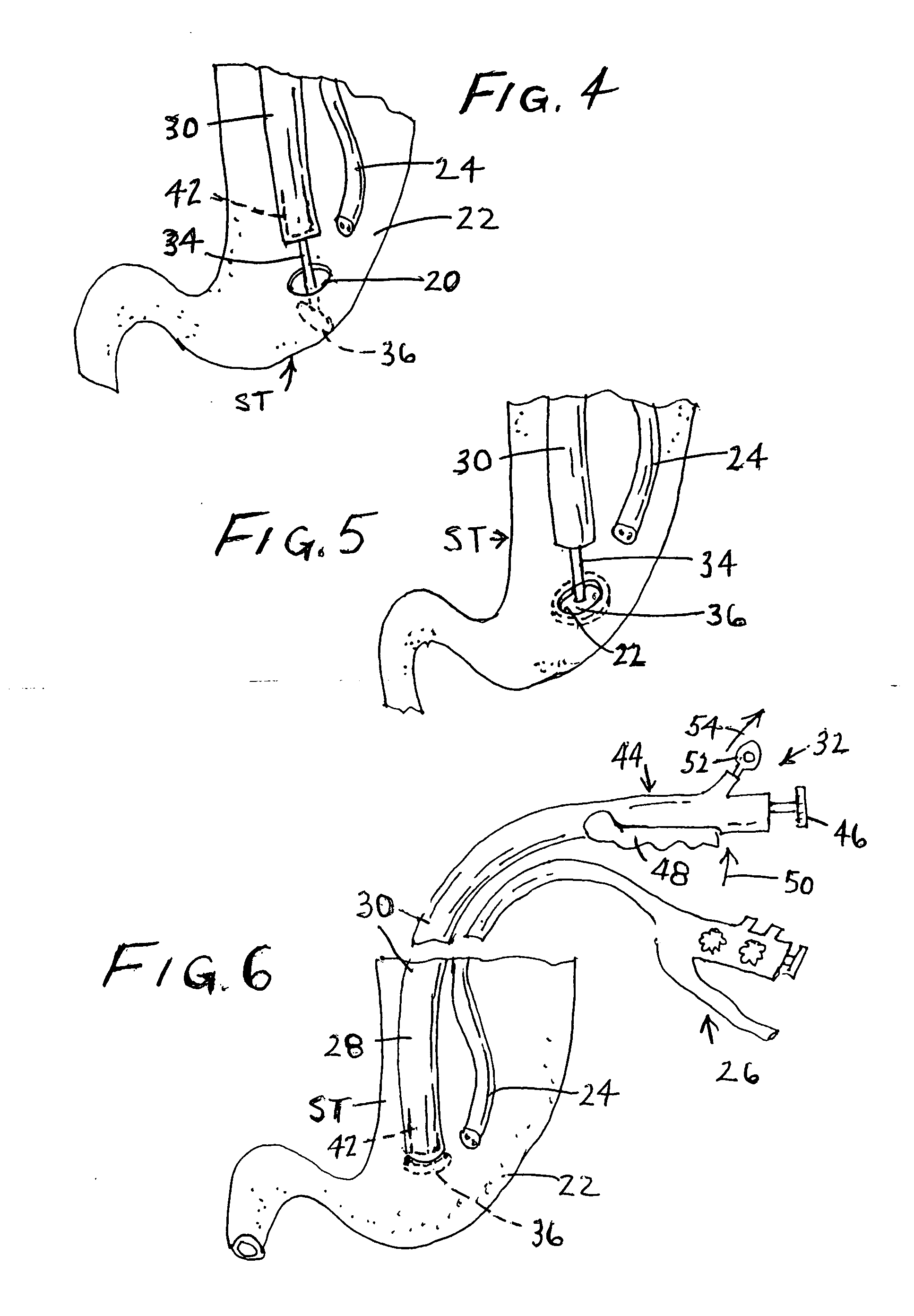 Surgical closure device and associated method