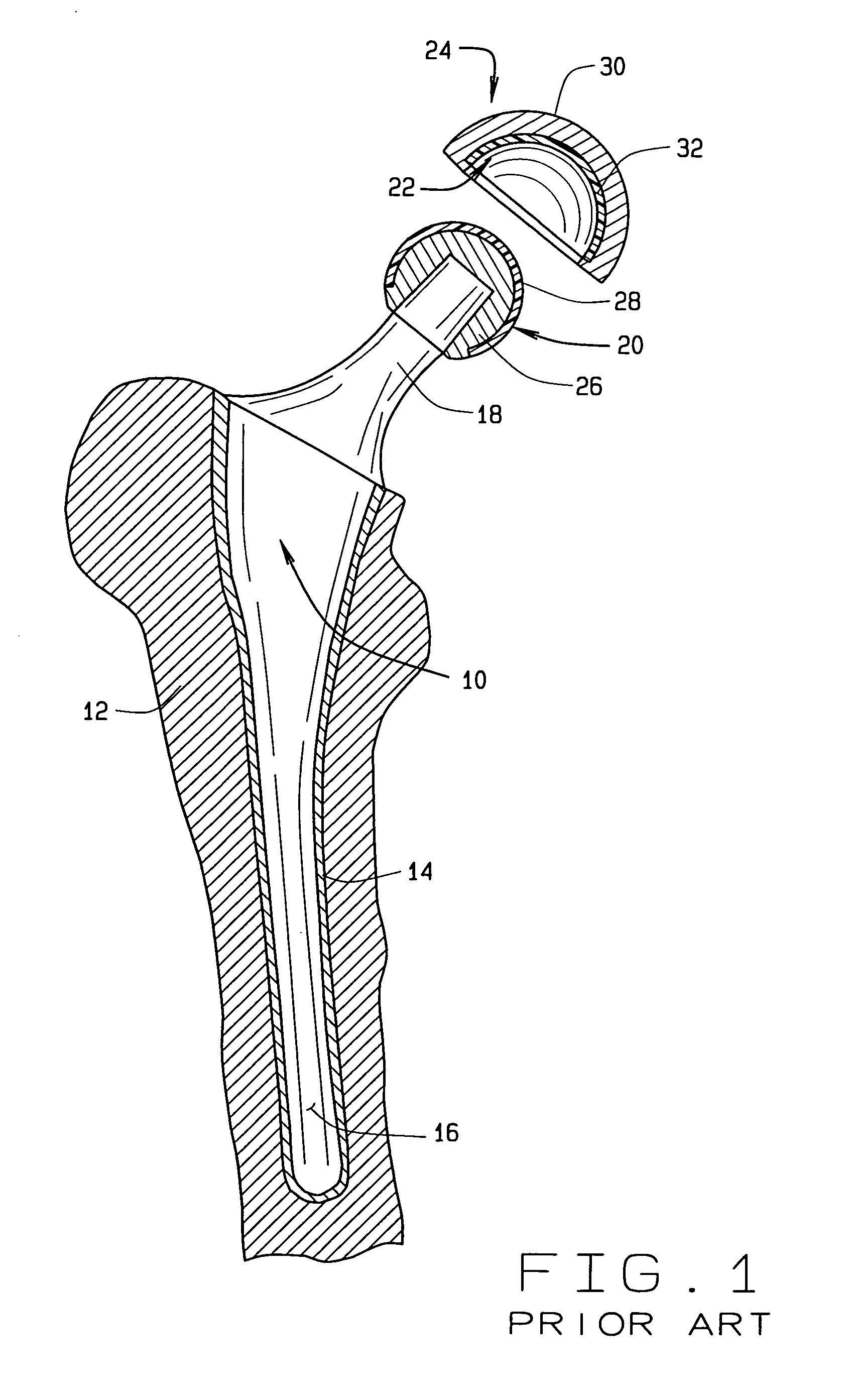 Coated ceramic total joint arthroplasty and method of making same
