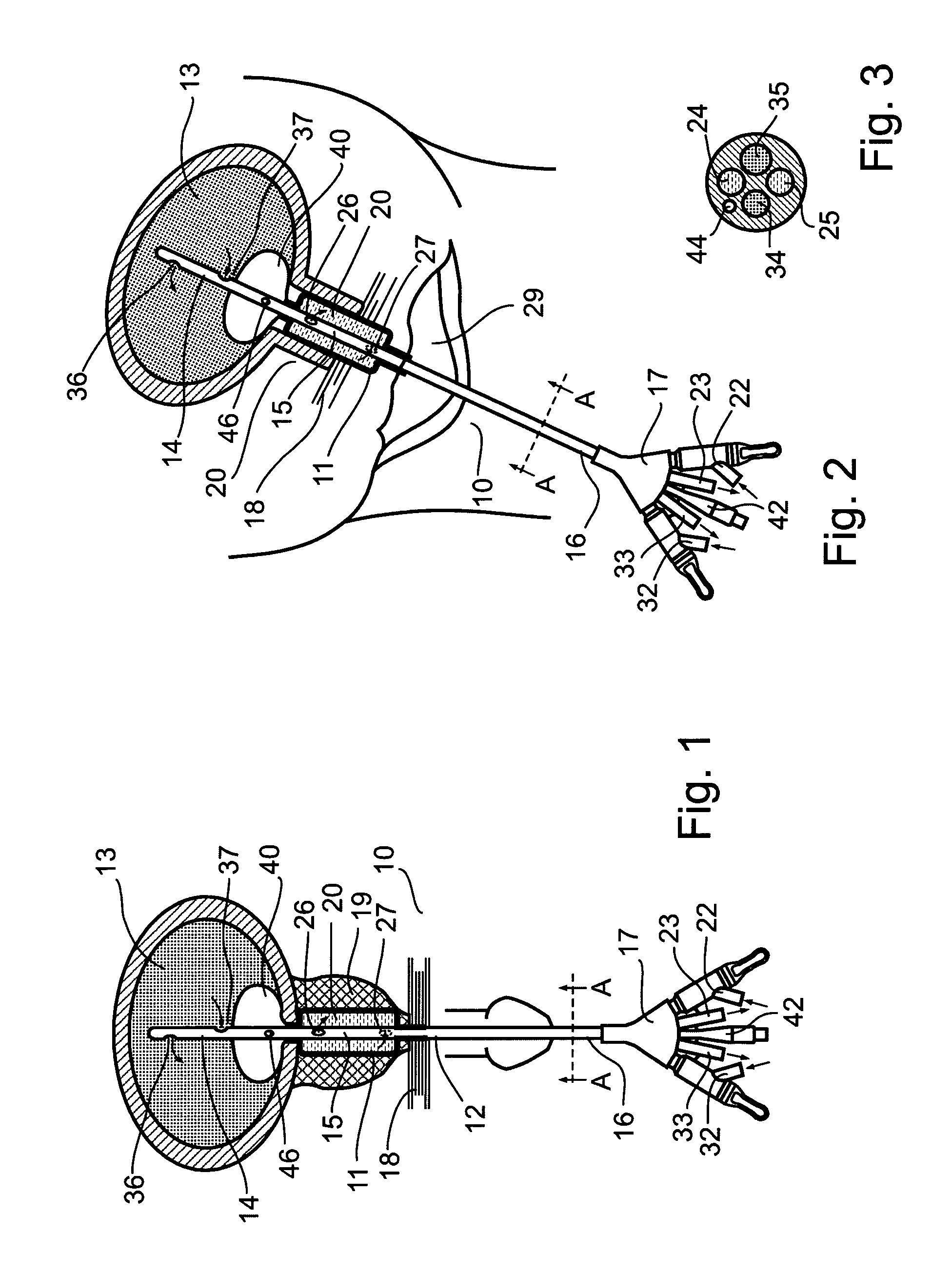 System and method for treating urinary tract disorders