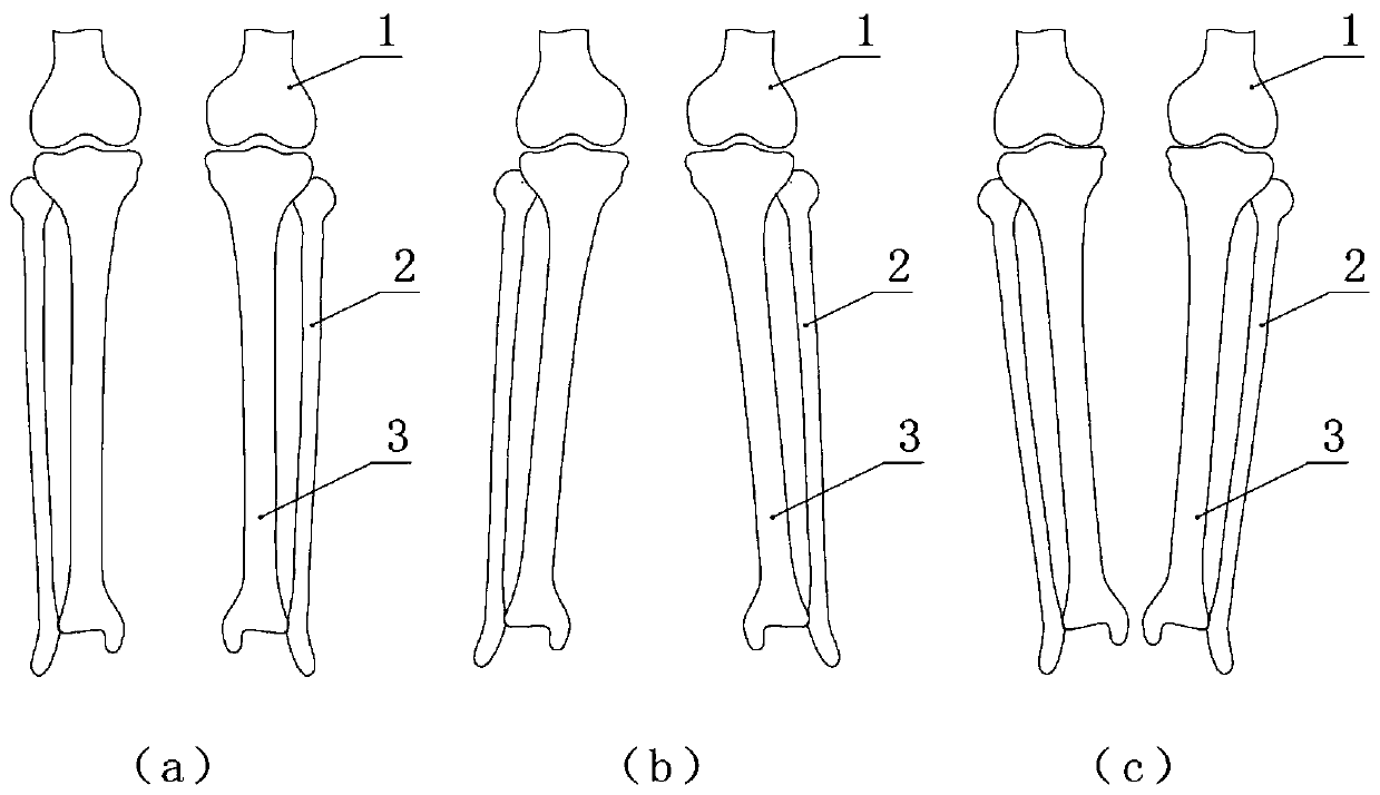 Tibia correcting device for treating knee-osteoarthritis varus-valgus deformities