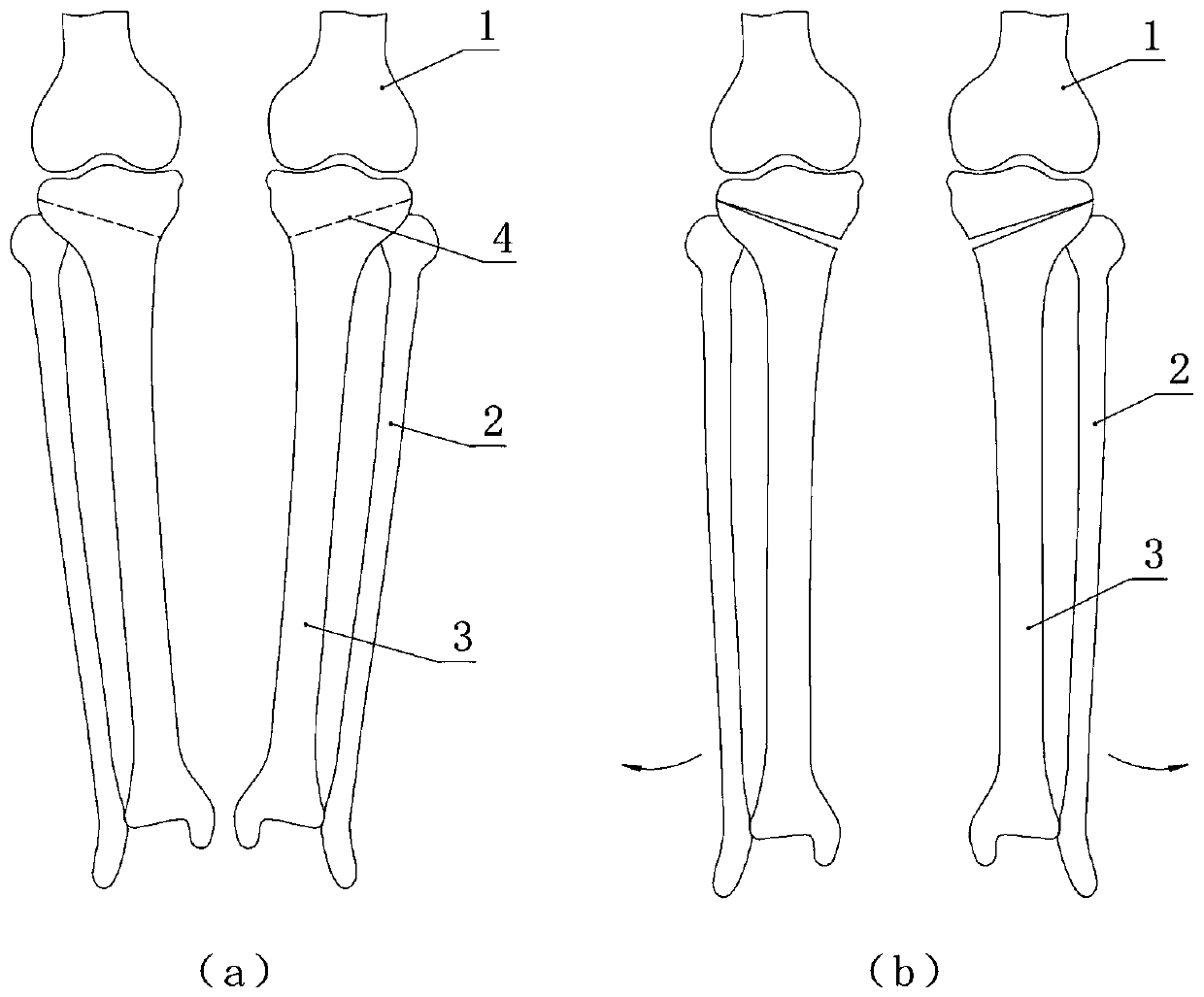 Tibia correcting device for treating knee-osteoarthritis varus-valgus deformities