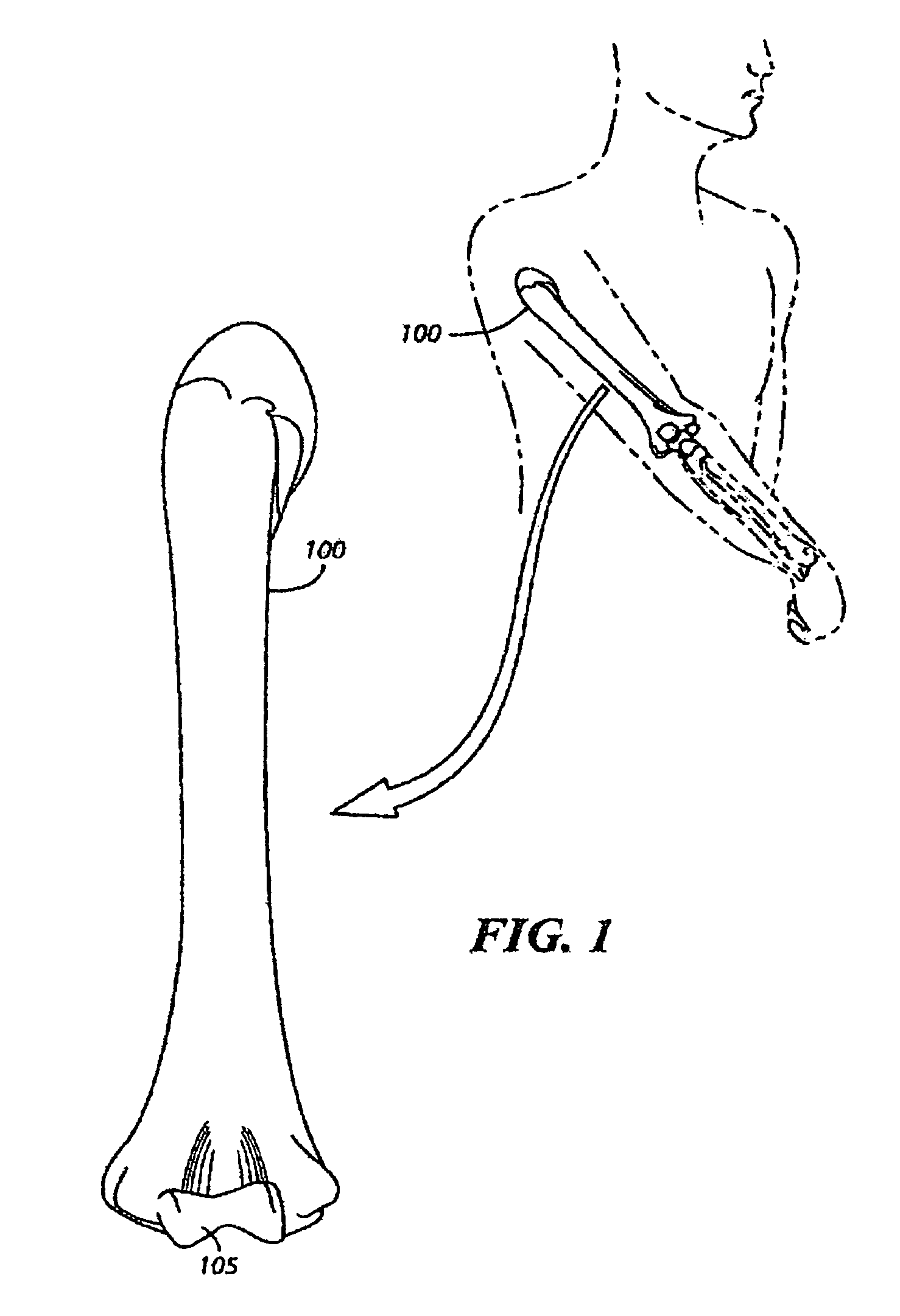 Fracture fixation system