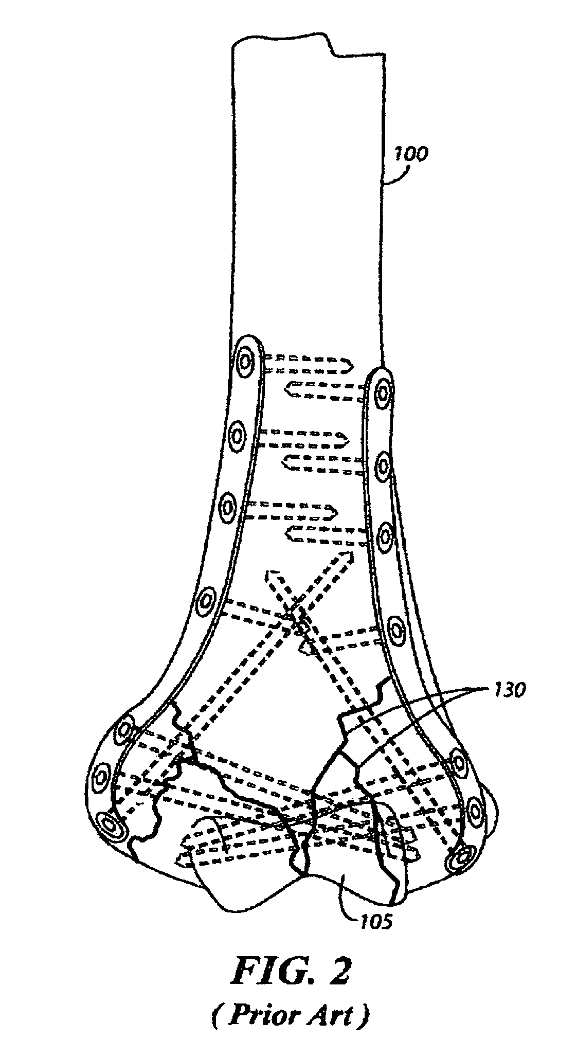 Fracture fixation system