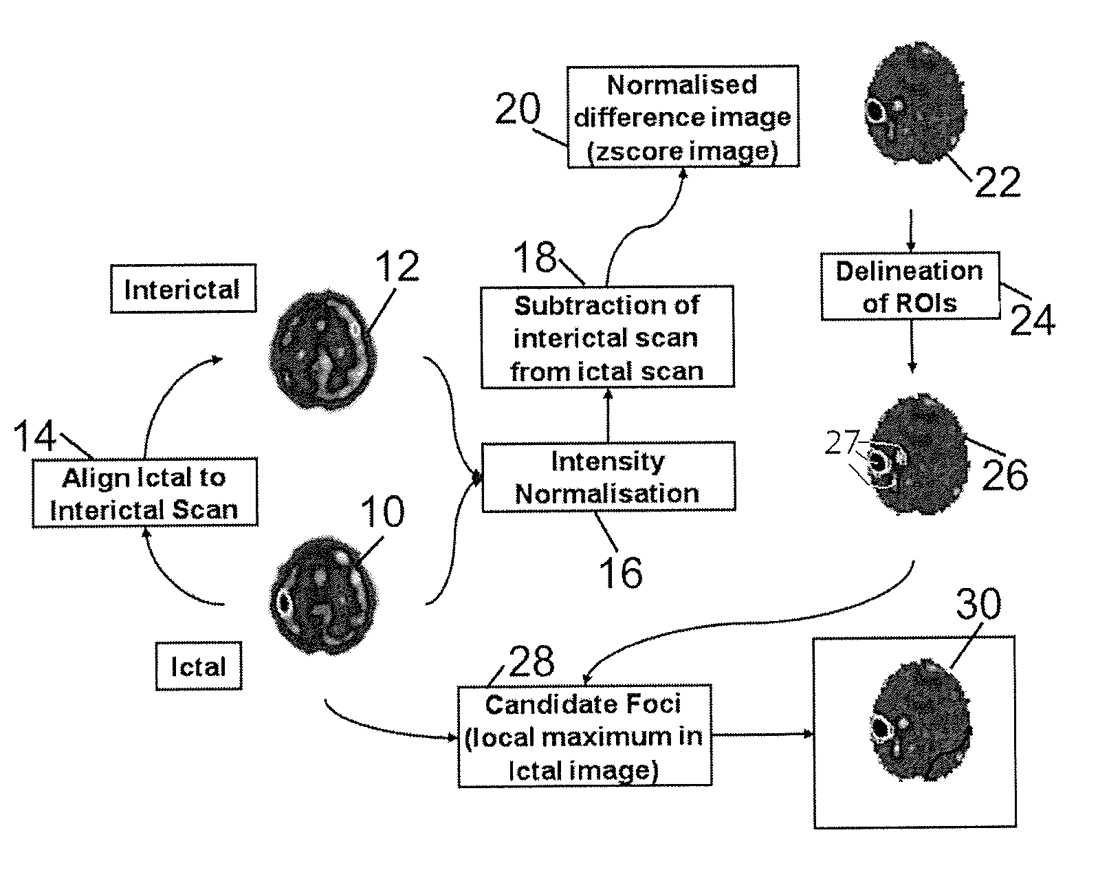 Method for localization of an epileptic focus in neuroimaging