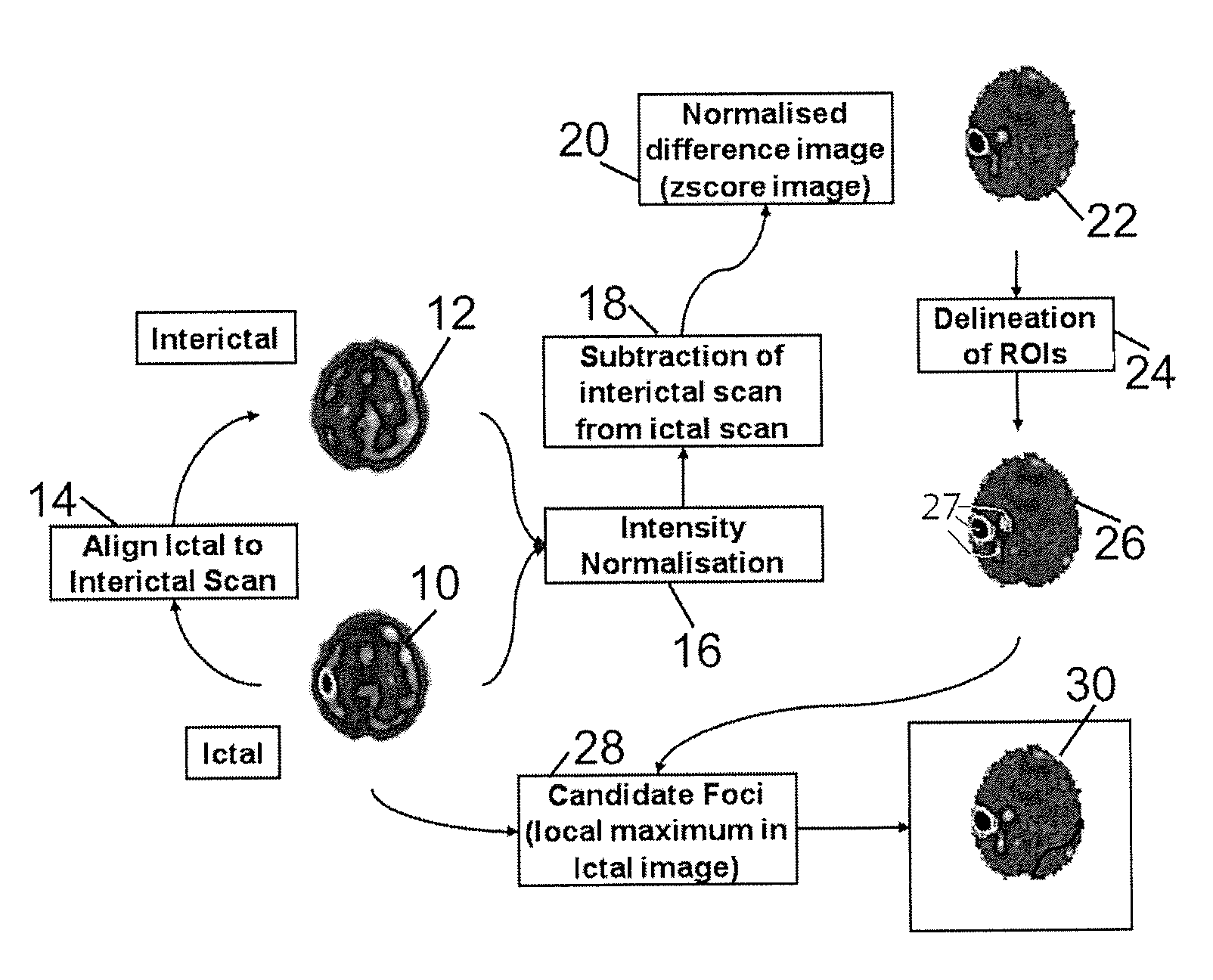Method for localization of an epileptic focus in neuroimaging